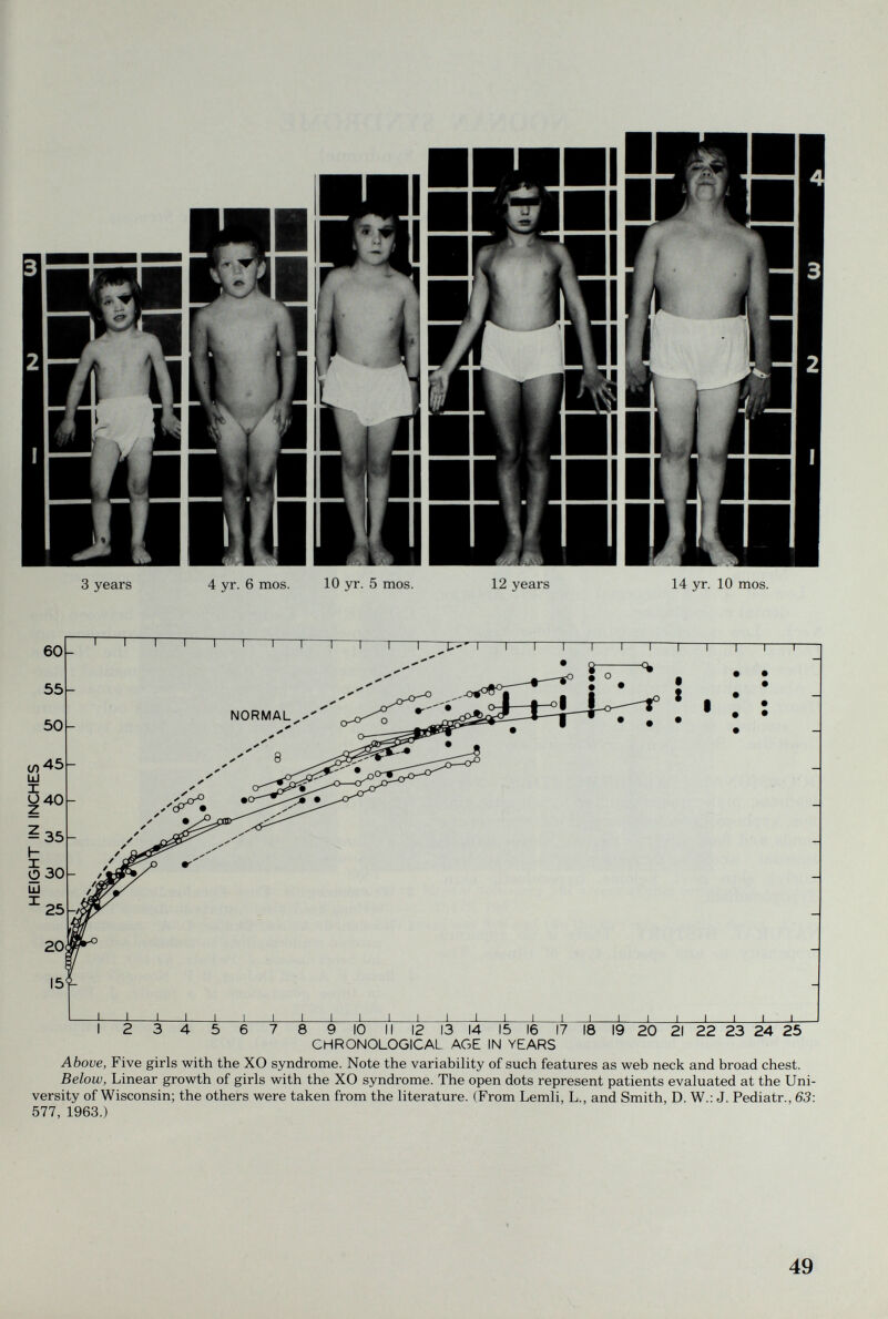 3 years 4 yr. 6 mos. 10 yr. 5 mos. 12 years 14 yr. 10 mos. Above, Five girls with the XO syndrome. Note the variability of such features as web neck and broad chest. Below, Linear growth of girls with the XO syndrome. The open dots represent patients evaluated at the Uni¬ versity of Wisconsin; the others were taken from the literature. (From Lemli, L., and Smith, D. W.: J. Pediatr., 63: 577, 1963.) 49