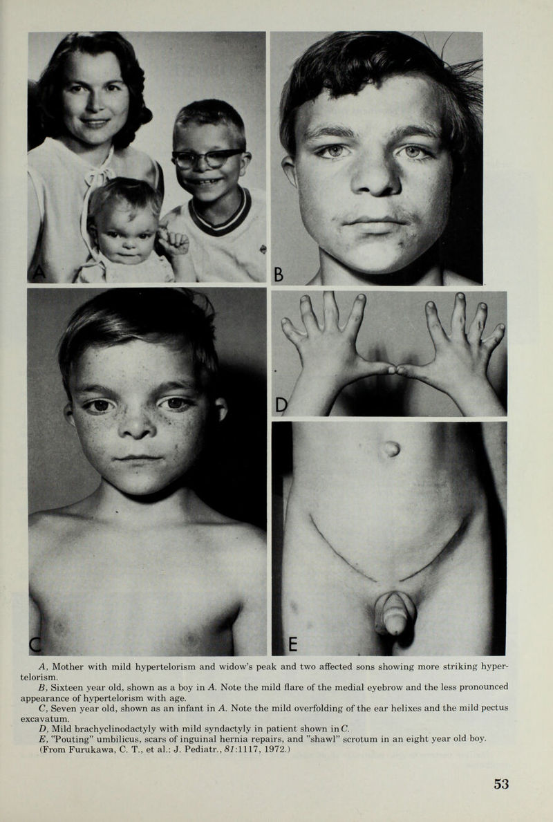 A, Mother with mild hypertelorism and widow's peak and two affected sons showing more striking hyper¬ telorism. B, Sixteen year old, shown as a boy in A. Note the mild flare of the medial eyebrow and the less pronounced appearance of hypertelorism with age. C, Seven year old, shown as an infant in A. Note the mild overfolding of the ear helixes and the mild pectus excavatum. D, Mild brachyclinodactyly with mild syndactyly in patient shown in C. E, Pouting umbilicus, scars of inguinal hernia repairs, and shawl scrotum in an eight year old boy. (From Furukawa, C. T., et al.: J. Pediatr., 81:1117, 1972.) 53