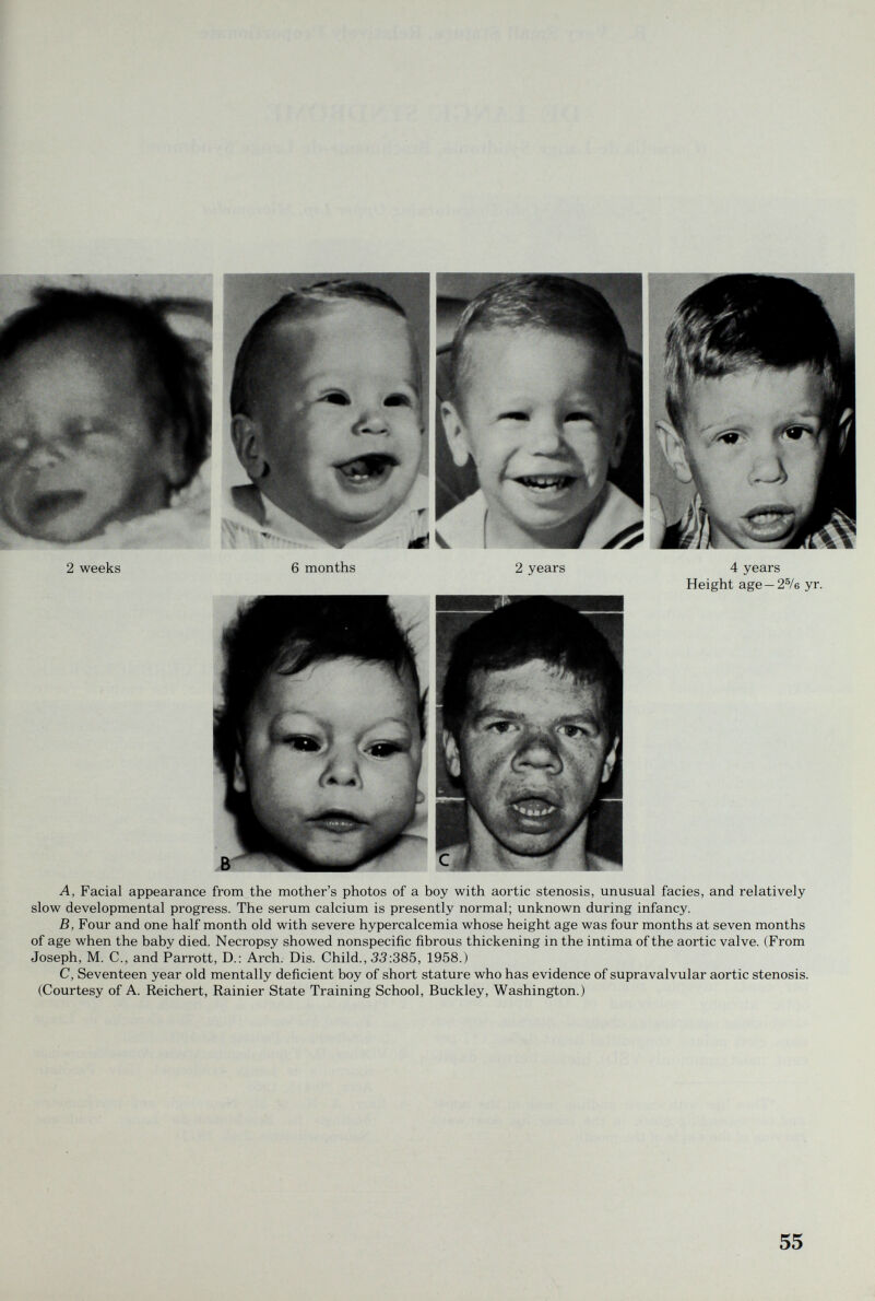 2 weeks 6 months 2 years 4 years Height age —2®/б yr. A, Facial appearance from the mother's photos of a boy with aortic stenosis, unusual facies, and relatively slow developmental progress. The serum calcium is presently normal; unknown during infancy. B, Four and one half month old with severe hypercalcemia whose height age was four months at seven months of age when the baby died. Necropsy showed nonspecific fibrous thickening in the intima of the aortic valve. (From Joseph, M. C., and Parrott, D.: Arch. Dis. Child., 53:385, 1958.) C, Seventeen year old mentally deficient boy of short stature who has evidence of supravalvular aortic stenosis. (Courtesy of A. Reichert, Rainier State Training School, Buckley, Washington.) 55