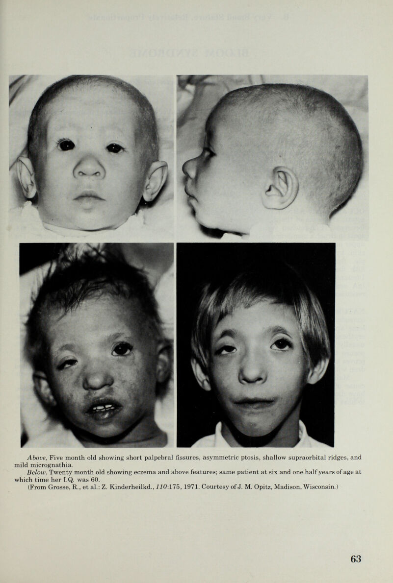 Above, Five month old showing short palpebral fissures, asymmetric ptosis, shallow supraorbital ridges, and mild micrognathia. Below, Twenty month old showing eczema and above features; same patient at six and one half years of age at which time her I.Q. was 60. (From Grosse, R., et al.: Z. Kinderheilkd., 110:175, 1971. Courtesy of J. M. Opitz, Madison, Wisconsin.) 63