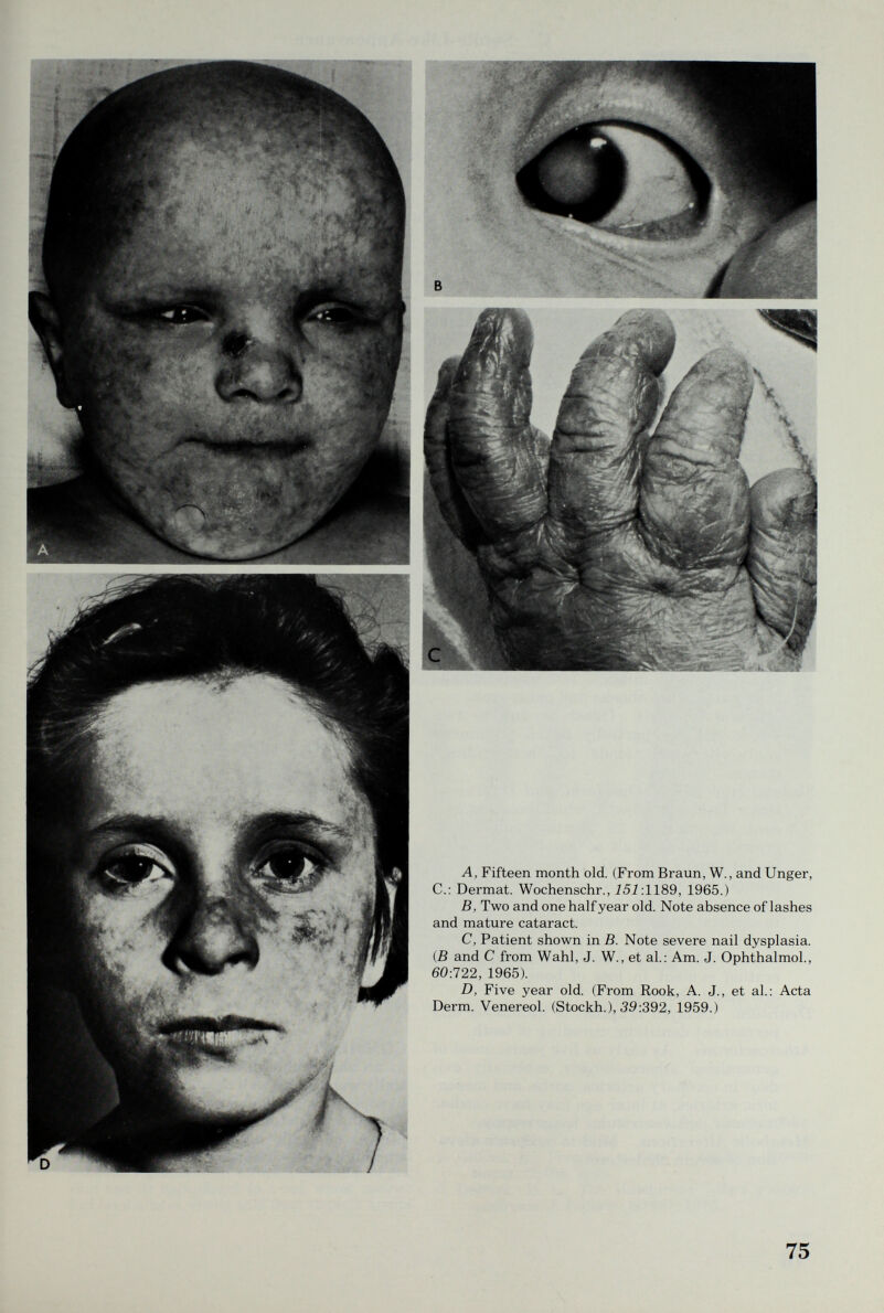 A, Fifteen month old. (From Braun, W., and Unger, е.: Dermat. Wochenschr., Ì5Ì:1189, 1965.) B, Two and one half year old. Note absence of lashes and mature cataract. C, Patient shown in B. Note severe nail dysplasia. {B and С from Wahl, J. W., et al.: Am. J. Ophthalmol., 60:722, 1965). D, Five year old. (From Rook, A. J., et al.: Acta Derm. Venereol. (Stockh.), 39:392, 1959.) 75