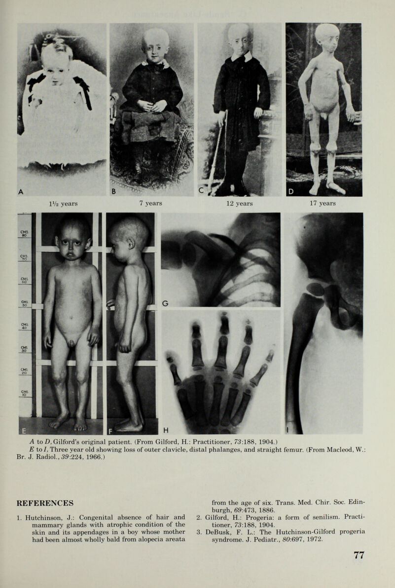 1V2 years 7 years 12 years 17 years A to D, Gilford's original patient. (From Gilford, H.: Practitioner, 73:188, 1904.) E to /, Three year old showing loss of outer clavicle, distal phalanges, and straight femur. (From Macleod, W.: Br. J. Radiol., 39:224, 1966.) REFERENCES 1. Hutchinson, J.: Congenital absence of hair and mammary glands with atrophic condition of the skin and its appendages in a boy whose mother had been almost wholly bald from alopecia areata from the age of six. Trans. Med. Chir. Soc. Edin¬ burgh, 69:473, 1886. 2. Gilford, H.: Progeria: a form of senilism. Practi¬ tioner, 73:188, 1904. 3. DeBusk, F. L.: The Hutchinson-Gilford progeria syndrome. J. Pediatr., 80:697, 1972. 77