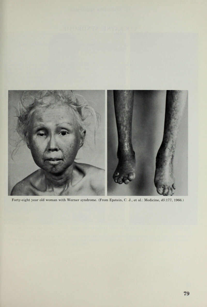 Forty-eight year old woman with Werner syndrome. (From Epstein, C. J., et al.: Medicine, 45:111, 1966.) 79