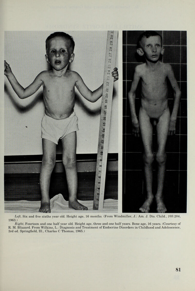 Left, Six and five sixths year old. Height age, 16 months. (From Windmiller, J.: Am. J. Dis. Child., 105:204, 1963.) Right, Fourteen and one half year old. Height age, three and one half years. Bone age, 16 years. (Courtesy of R. M. Blizzard. From Wilkins, L.: Diagnosis and Treatment of Endocrine Disorders in Childhood and Adolescence, 3rd ed. Springfield, 111., Charles С Thomas, 1965.) 81