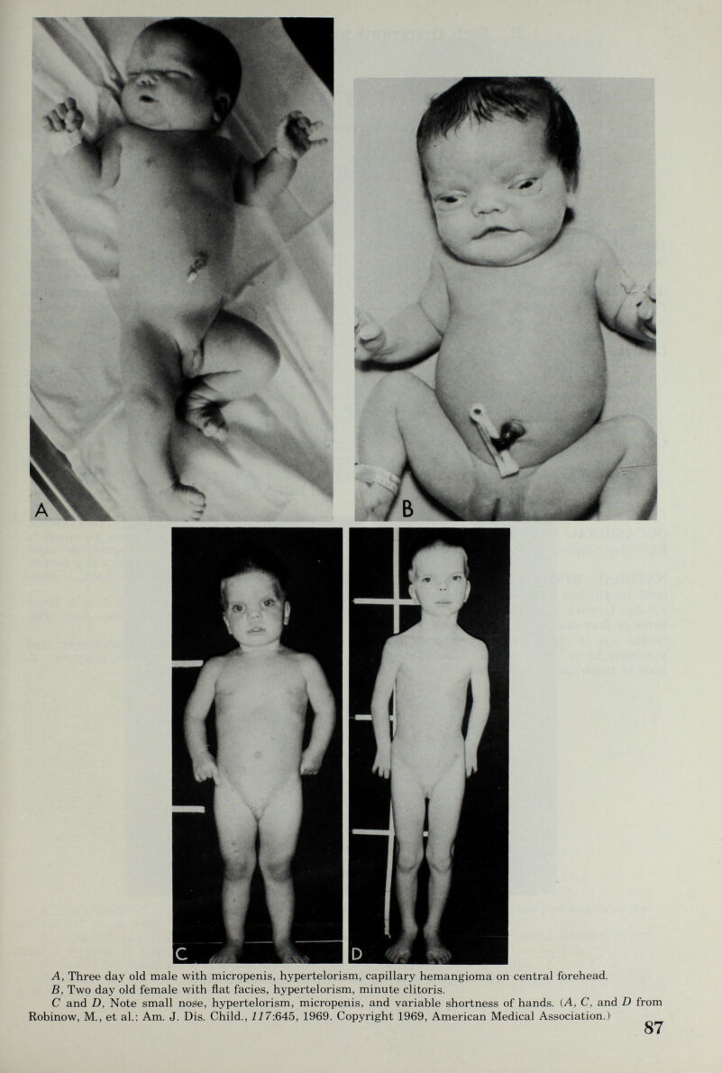 A, Three day old male with micropenis, hypertelorism, capillary hemangioma on central forehead. B, Two day old female with flat facies, hypertelorism, minute clitoris. С and D, Note small nose, hypertelorism, micropenis, and variable shortness of hands. {A, C, and D from Robinow, M., et al.: Am. J. Dis. Child., 117:645, 1969. Copyright 1969, American Medical Association.) 87