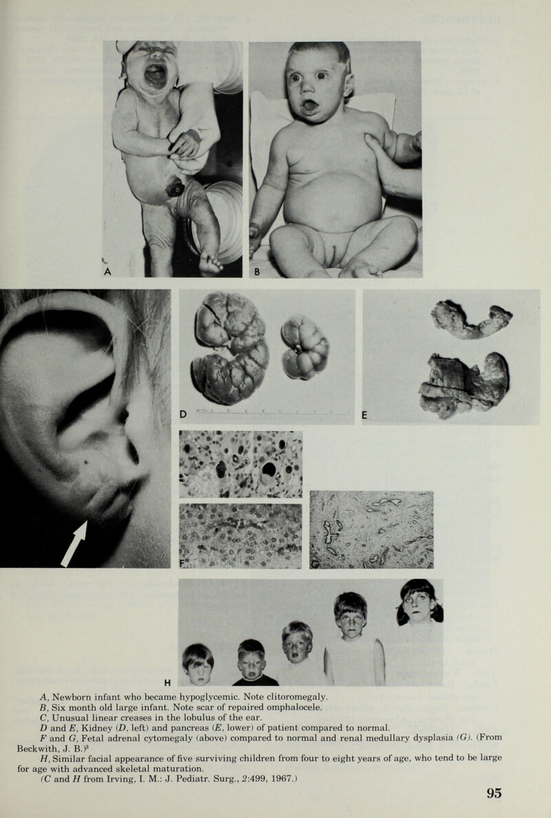 A, Newborn infant who became hypoglycemic. Note clitoromegaly. B, Six month old large infant. Note scar of repaired omphalocele. C, Unusual linear creases in the lobulus of the ear. D and E, Kidney (D, left) and pancreas {E, lower) of patient compared to normal. F and G, Fetal adrenal cytomegaly (above) compared to normal and renal medullary dysplasia (G). (From Beckwith, J. B.)® H, Similar facial appearance of five surviving children from four to eight years of age, who tend to be large for age with advanced skeletal maturation. (C and H from Irving, I. M.: J. Pediatr. Surg., 2:499, 1967.) 95