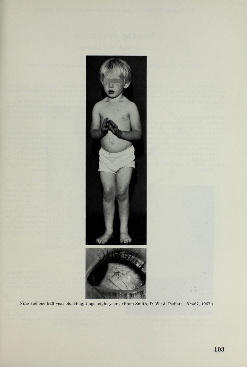 Nine and one half year old. Height age, eight years. (From Smith, D. W.: J. Pediatr., 70:487, 1967.) 103