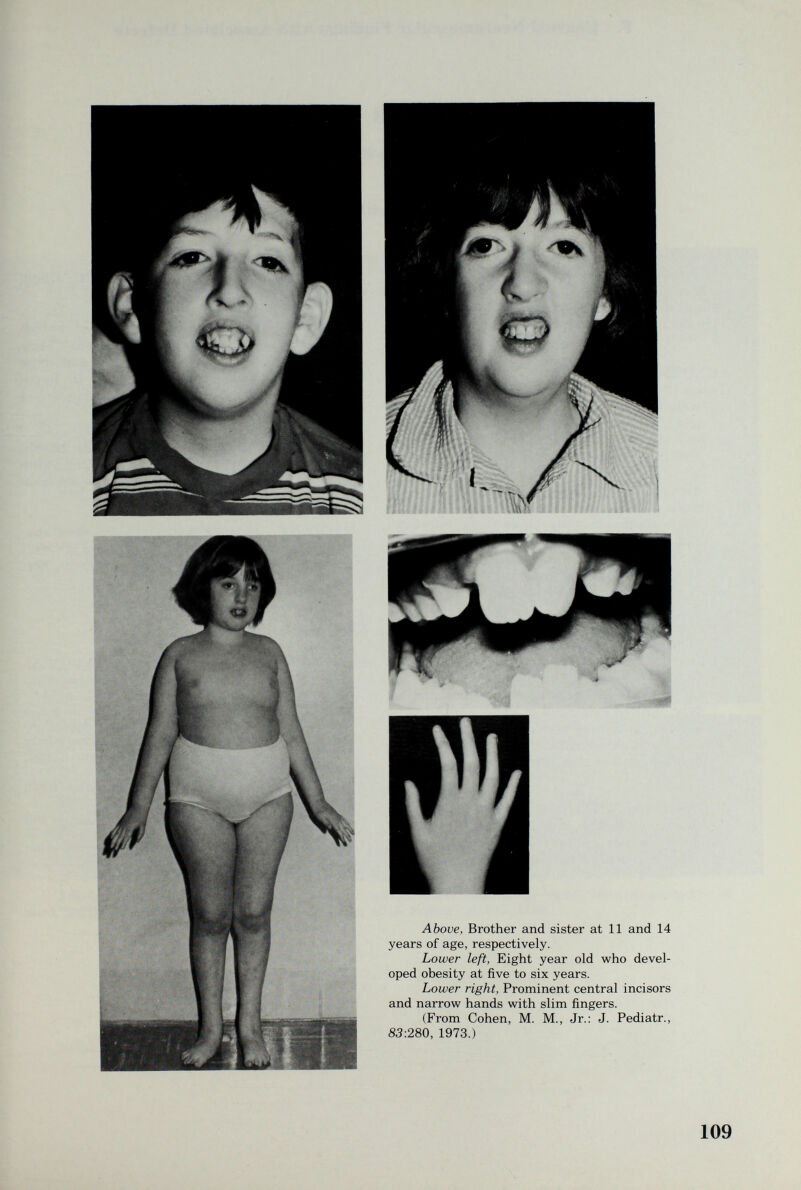 Above, Brother and sister at 11 and 14 years of age, respectively. Lower left, Eight year old who devel¬ oped obesity at five to six years. Lower right, Prominent central incisors and narrow hands with slim fingers. (From Cohen, M. M., Jr.: J. Pediatr., 83:280, 1973.) 109