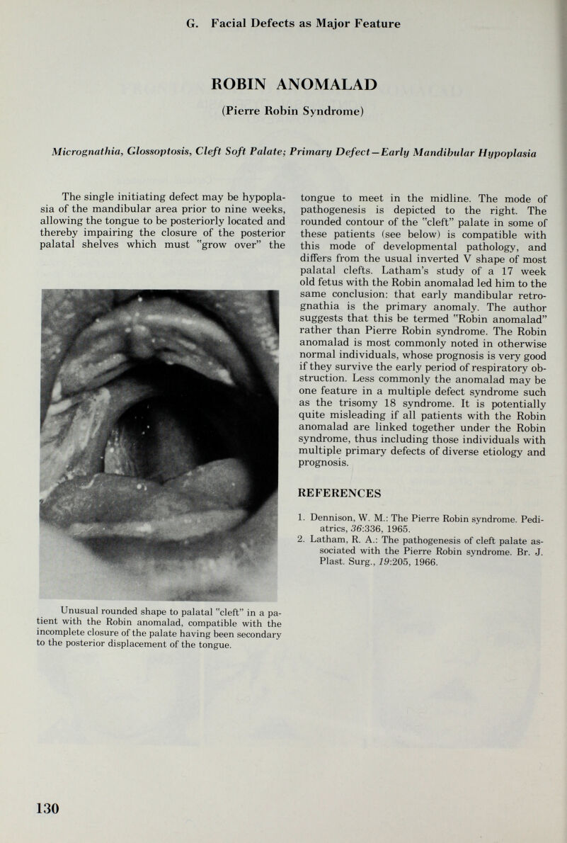 G. Facial Defects as Major Feature ROBIN ANOMALAD (Pierre Robin Syndrome) Micrognathia, Glossoptosis, Cleft Soft Palate; Primary Defect —Early Mandibular Hypoplasia The single initiating defect may be hypopla¬ sia of the mandibular area prior to nine weeks, allowing the tongue to be posteriorly located and thereby impairing the closure of the posterior palatal shelves which must grow over the tongue to meet in the midline. The mode of pathogenesis is depicted to the right. The rounded contour of the cleft palate in some of these patients (see below) is compatible with this mode of developmental pathology, and differs from the usual inverted V shape of most palatal clefts. Latham's study of a 17 week old fetus with the Robin anomalad led him to the same conclusion: that early mandibular retro- gnathia is the primary anomaly. The author suggests that this be termed Robin anomalad rather than Pierre Robin syndrome. The Robin anomalad is most commonly noted in otherwise normal individuals, whose prognosis is very good if they survive the early period of respiratory ob¬ struction. Less commonly the anomalad may be one feature in a multiple defect syndrome such as the trisomy 18 syndrome. It is potentially quite misleading if all patients with the Robin anomalad are linked together under the Robin syndrome, thus including those individuals with multiple primary defects of diverse etiology and prognosis. REFERENCES 1. Dennison, W. M.: The Pierre Robin syndrome. Pedi¬ atrics, 36:336, 1965. 2. Latham, R. A.; The pathogenesis of cleft palate as¬ sociated with the Pierre Robin syndrome. Br. J. Plast. Surg., 19:205, 1966. Unusual rounded shape to palatal cleft in a pa¬ tient with the Robin anomalad, compatible with the incomplete closure of the palate having been secondary to the posterior displacement of the tongue. 130