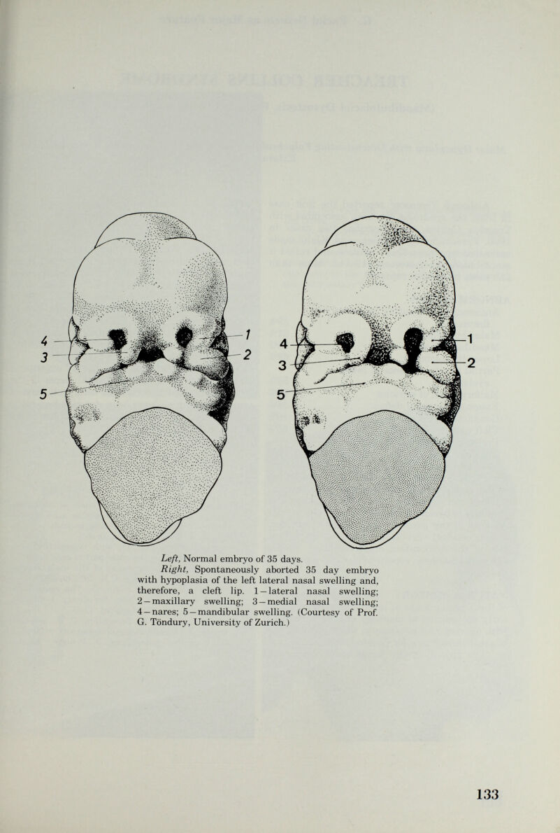 Left, Normal embryo of 35 days. Right, Spontaneously aborted 35 day embryo with hypoplasia of the left lateral nasal swelling and, therefore, a cleft lip. 1 —lateral nasal swelling; 2 —maxillary swelling; 3 —medial nasal swelling; 4 —nares; 5 —mandibular swelling. (Courtesy of Prof. G. Töndury, University of Zurich.)