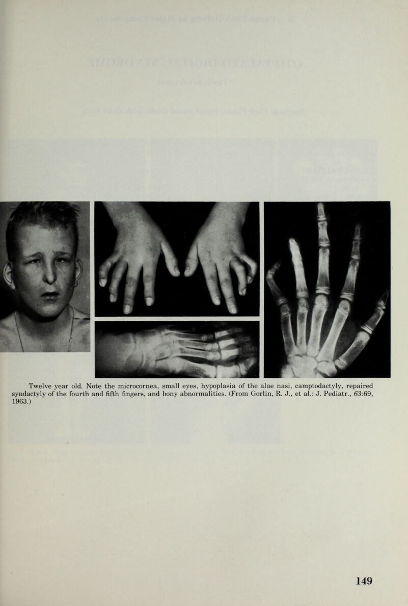 Twelve year old. Note the microcornea, small eyes, hypoplasia of the alae nasi, camptodactyly, repaired syndactyly of the fourth and fifth fingers, and bony abnormalities. (From Gorlin, R. J., et al.: J. Pediatr., 63:69, 1963.) 149