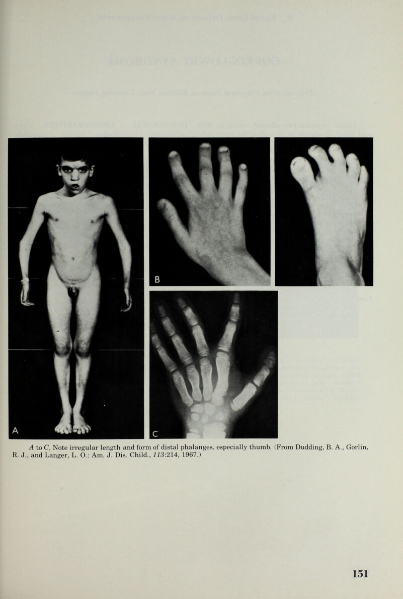 A to С, Note irregular length and form of distal phalanges, especially thumb. (From Dudding, B. A., Gorlin, R. J., and Langer, L. O.: Am. J. Dis. Child., 113:214, 1967.) 151