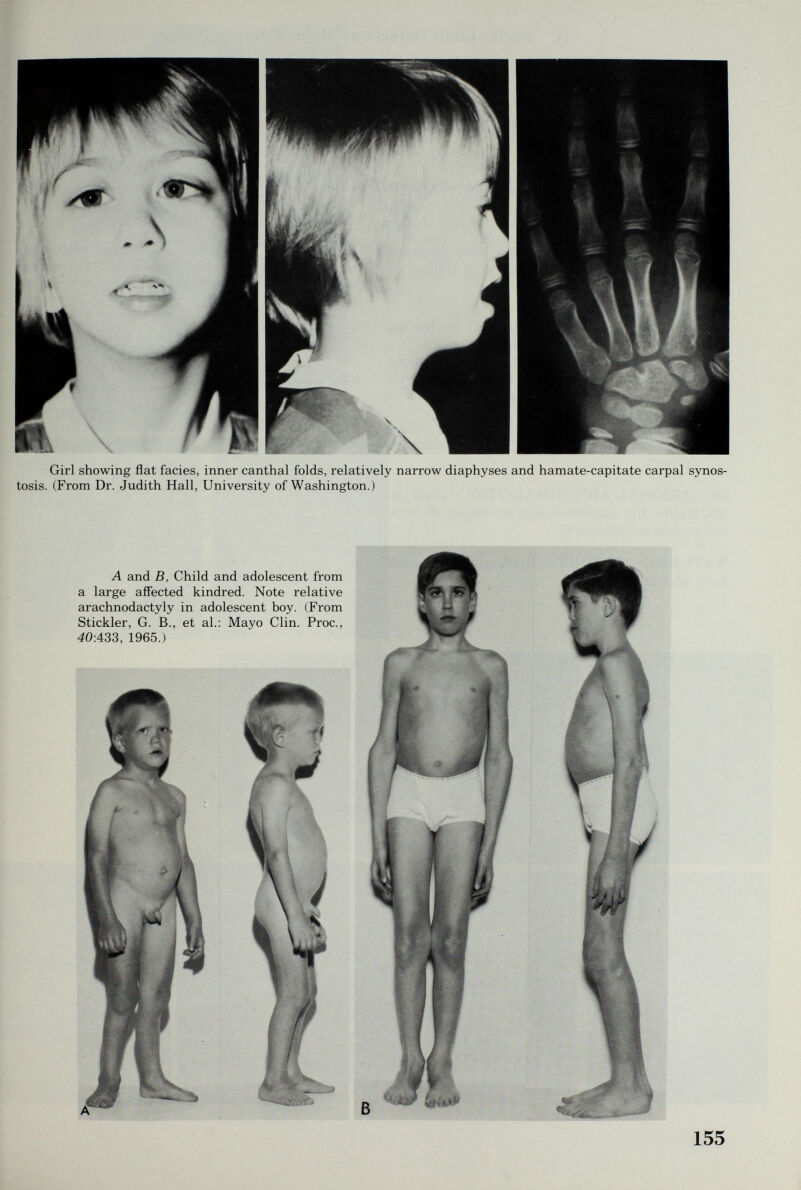 Girl showing flat facies, inner canthal folds, relatively narrow diaphyses and hamate-capitate carpal synos¬ tosis. (From Dr. Judith Hall, University of Washington.) A and B, Child and adolescent from a large affected kindred. Note relative arachnodactyly in adolescent boy. (From Stickler, G. В., et al.: Mayo Clin. Proc., 40:433, 1965.)