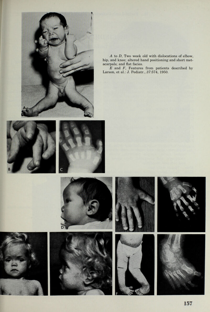 A to D, Two week old with dislocations of elbow, hip, and knee; altered hand positioning and short met¬ acarpals; and flat facies. E and F, Features from patients described by Larson, et al.: J. Pediatr., 37:574, 1950. Щ F |%;,у 157