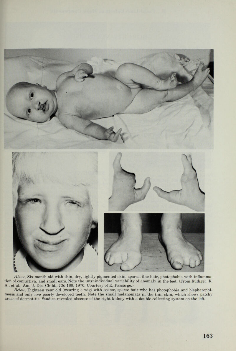 Above, Six month old with thin, dry, lightly pigmented skin, sparse, fine hair, photophobia with inflamma¬ tion of conjuctiva, and small ears. Note the intraindividual variability of anomaly in the feet. (From Rüdiger, R. A., et al.: Am. J. Dis. Child., 120:160, 1970. Courtesy of E. Passarge.) Below, Eighteen year old (wearing a wig) with coarse, sparse hair who has photophobia and blepharophi- mosis and only five poorly developed teeth. Note the small melanomata in the thin skin, which shows patchy areas of dermatitis. Studies revealed absence of the right kidney with a double collecting system on the left. 163