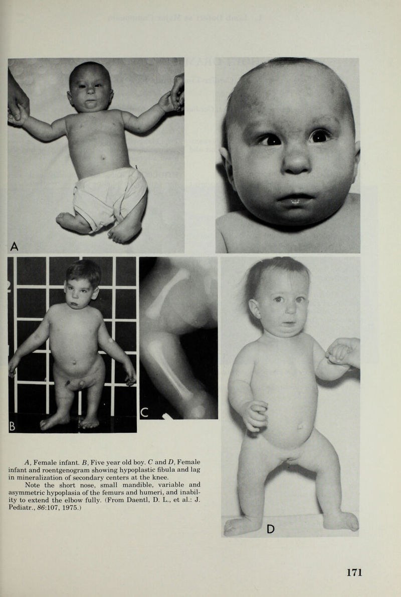 A, Female infant. B, Five year old boy. С and D, Female infant and roentgenogram showing hypoplastic fibula and lag in mineralization of secondary centers at the knee. Note the short nose, small mandible, variable and asymmetric hypoplasia of the femurs and humeri, and inabil¬ ity to extend the elbow fully. (From Daentl, D. L., et al.: J. Pediatr., 86:107, 1975.)