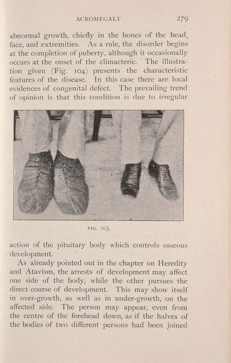 ACROMEGALY 279 abnormal growth, chiefly in the bones of the head, face, and extremities. As a rule, the disorder begins at the completion of puberty, although it occasionally occurs at the onset of the climacteric. The illustra¬ tion given (Fig. 104) presents the characteristic features of the disease. In this case there are local evidences of congenital defect. The prevailing trend of opinion is that this condition is due to irregular FIG. 105. action of the pituitary body which controls osseous development. As already pointed out in the chapter on Heredity and Atavism, the arrests of development may affect one side of the body, while the other pursues the direct course of development. ' This may show itself in over-growth, as well as in under-growth, on the affected side. The person may appear, even from the centre of the forehead down, as if the halves of the bodies of two different persons had been joined