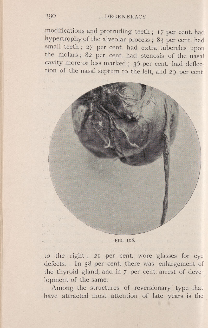 290 DEGENERACY modifications and protruding teeth ; 17 per cent, had hypertrophy of the alveolar process ; 83 per cent, had small teeth ; 27 per cent, had extra tubercles upon the molars ; 82 per cent, had stenosis of the nasal cavity more or less marked ; 36 per cent, had deflec¬ tion of the nasal septum to the left, and 29 per cent FIG. 108. to the right;: 21 per cent, wore glasses for eye defects. In 58 per cent, there was enlargement of the thyroid gland, and in 7 per cent, arrest of deve¬ lopment of the same. Among the structures of reversionary type that have attracted most attention of late years is the
