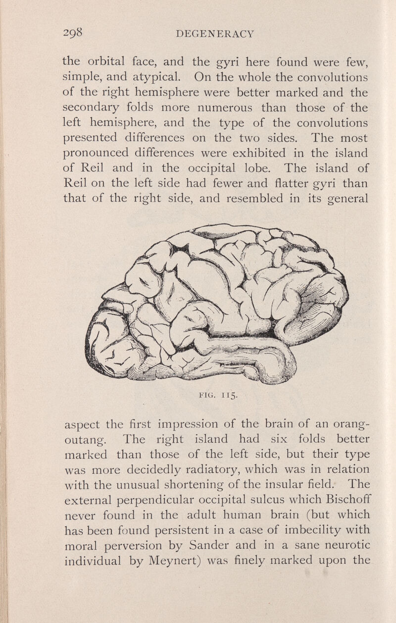298 DEGENERACY the orbital face, and the gyri here found were few, simple, and atypical. On the whole the convolutions of the right hemisphere were better marked and the secondary folds more numerous than those of the left hemisphere, and the type of the convolutions presented differences on the two sides. The most pronounced differences were exhibited in the island of Reil and in the occipital lobe. The island of Reil on the left side had fewer and flatter gyri than that of the right side, and resembled in its general aspect the first impression of the brain of an orang¬ outang. The right island had six folds better marked than those of the left side, but their type was more decidedly radiatory, which was in relation with the unusual shortening of the insular field. The external perpendicular occipital sulcus which Bischoff never found in the adult human brain (but which has been found persistent in a case of imbecility with moral perversion by Sander and in a sane neurotic individual by Meynert) was finely marked upon the