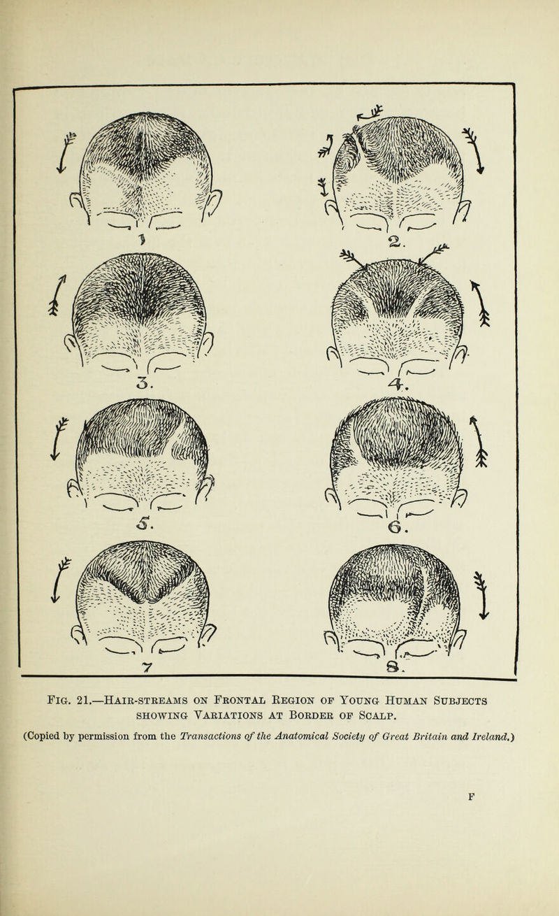 г- Fig, 21.—Hair-streams on Frontal Eegion of Young Human Subjects showing Variations at Border of Scalp. t, ! (Copied by permission from the Transactions of the Anatomical Society of Great Britain and Ireland,') f