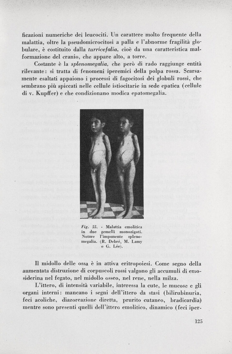 ficazioni numeriche dei leucociti. Un carattere molto frequente della malattia, oltre la pseudomicrocitosi a palla e l'abnorme fragilità glo bulare, è costituito dalla turricefalia, cioè da una caratteristica mal formazione del cranio, che appare alto, a torre. Costante è la splenomegalia, che però di rado raggiunge entità rilevante: si tratta di fenomeni iperemici della polpa rossa. Scarsa mente esaltati appaiono i processi di fagocitosi dei globuli rossi, che sembrano più spiccati nelle cellule istiocitarie in sede epatica (cellule di v. Kupffer) e che condizionano modica epatomegalia. Fig. 55. - Malattia emolitica in due gemelli monozigoti. Notare l'imponente spleno megalia. (R. Debré, M. Lamy e G. Lée). Il midollo delle ossa è in attiva eritropoiesi. Come segno della aumentata distruzione di corpuscoli rossi valgono gli accumuli di emo- siderina nel fegato, nel midollo osseo, nel rene, nella milza. L'ittero, di intensità variabile, interessa la cute, le mucose e gli organi interni: mancano i segni dell'ittero da stasi (bilirubinuria, feci acoliche, diazoreazione diretta, prurito cutaneo, bradicardia) mentre sono presenti quelli dell'ittero emolitico, dinamico (feci iper-