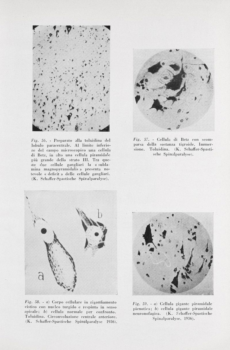 - * i il u *,■ t f *» f ? *' 4 » r •? t. # ». ,1 y . ' % » '»; ■ t * ' p T é. % ' *4 '* • •* T •' • e 'y * \ V 1 h : * * ■ tv- V •> f » * Î i « * ? >' ^ * . . * 1 • • f .»* * * ♦ r * * Fig. 56. - Preparato alla toluidina del lobulo paracentrale. Al limite inferio re del campo microscopico una cellula di Betz, in alto una cellula piramidale più grande dello strato III. Tra que ste due cellule gangliari la « subla mina magnopyramidalis » presenta no tevole « deficit » delle cellule gangliari. (K. Schaffer-Spastische Spinalparalyse). * *' Fig. 57. - Cellula di Betz con scom parsa della sostanza tigroide. Immer sione. Toluidina. (K. Schaffer-Spasti sche Spinalparalyse). Fig. 58. - a) Corpo cellulare in rigonfiamento cistico con nucleo turgido e respinto in senso apicale; b) cellula normale per confronto. Toluidina. Circonvoluzione centrale anteriore. (K. Schaffer-Spastische Spinalparalyse 1936). Fig. 59. - a) Cellula gigante piramidale picnotica; b) cellula gigante piramidale neuronofagica. (K. Schaffer-Spastische Spinalparalyse, 1936).