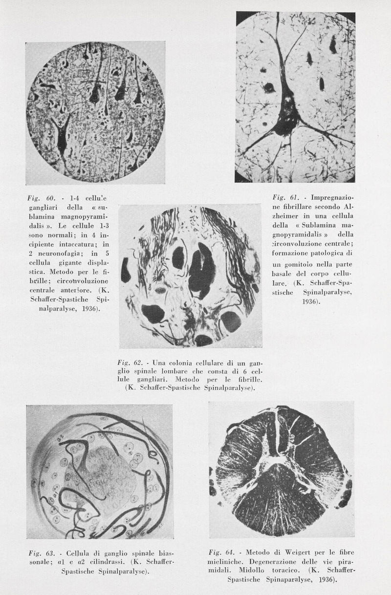 Fig. 60. - 1-4 cellu'e gangliari della « su- blaniina magnopyrami- dalis ». Le cellule 1-3 sono normali ; in 4 in cipiente intaccatura; in 2 neuronofagia ; in 5 cellula gigante displa stica. Metodo per le fi- brille ; circolivoluzione centrale anteriore. (K. Sdì äff er -Spasti c li e Spi nalparalyse, 1936). Fig. 61. - Impregnazio ne fibrillare secondo Al zheimer in una cellula della « Sublamina ma- gnopyramidalis » della circonvoluzione centrale ; formazione patologica di un gomitolo nella parte basale del corpo cellu lare. (K. Schaffer-Spa- stische Spinalparalyse, 1936). Fig. 62. - Una colonia cellulare di un gan glio spinale lombare che consta di 6 cel lule gangliari. Metodo per le fibrille. (K. Schaffer-Spastische Spinalparalyse). Fig. 63. - Cellula di ganglio spinale bias- sonale; al e a2 cilindrassi. (K. Schaffer- Spastische Spinalparalyse). Fig. 64. - Metodo di Weigert per le fibre mieliniche. Degenerazione delle vie pira midali. Midollo toracico. (K. Schaffer- Spastische Spinaparalyse, 1936).