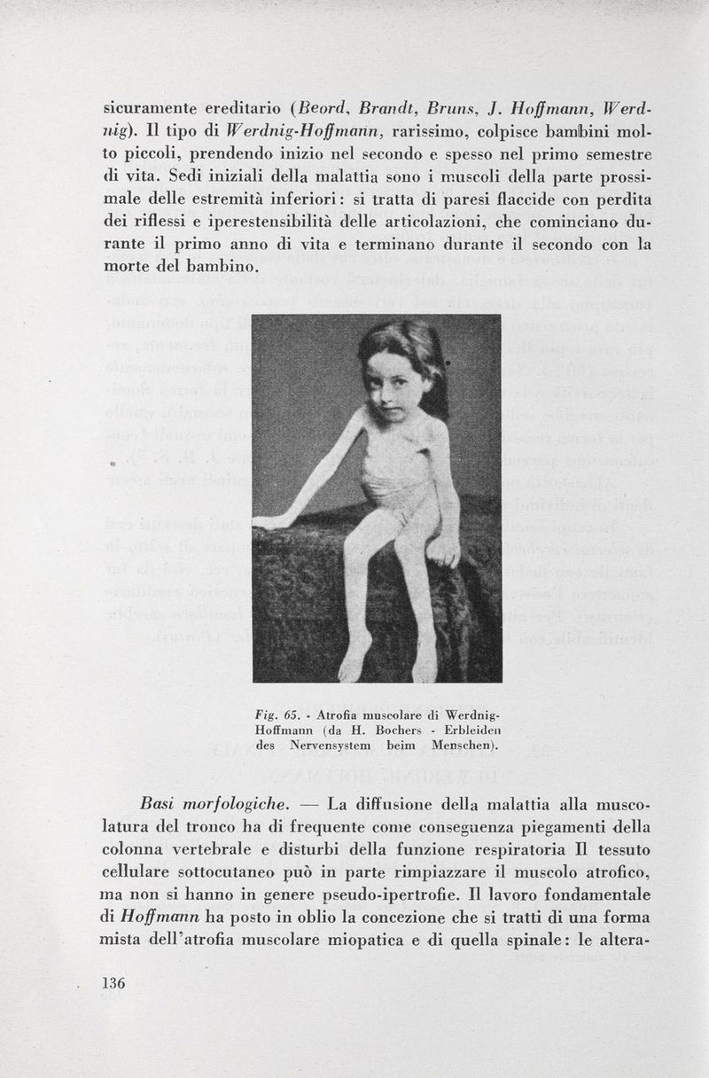 sicuramente ereditario ( Beord, Brandt, Bruns, J. Hoffmann, ÏFerd- nig). Il tipo di W'erdnig-Hoffmann, rarissimo, colpisce bambini mol to piccoli, prendendo inizio nel secondo e spesso nel primo semestre di vita. Sedi iniziali della malattia sono i muscoli della parte prossi male delle estremità inferiori : si tratta di paresi flaccide con perdita dei riflessi e iperestensibilità delle articolazioni, che cominciano du rante il primo anno di vita e terminano durante il secondo con la morte del bambino. Fig. 65. • Atrofia muscolare di Werdnig- Hoffmann (da H. Bochers - Erbleiden des Nervensystem beim Menschen). Basi morfologiche. — La diffusione della malattia alla musco latura del tronco ha di frequente come conseguenza piegamenti della colonna vertebrale e disturbi della funzione respiratoria II tessuto cellulare sottocutaneo può in parte rimpiazzare il muscolo atrofico, ma non si hanno in genere pseudo-ipertrofie. Il lavoro fondamentale di Hoffmann ha posto in oblio la concezione che si tratti di una forma mista dell'atrofia muscolare miopatica e di quella spinale: le altera
