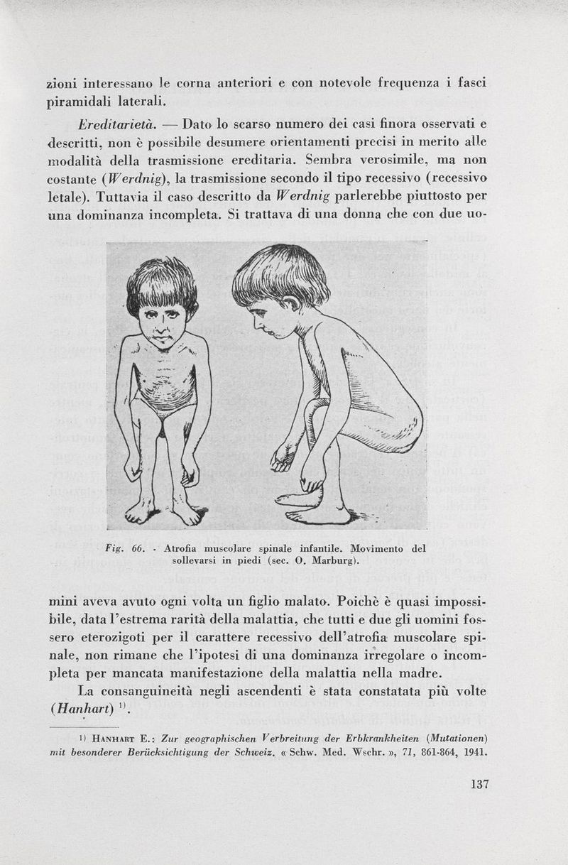zioni interessano le corna anteriori e con notevole frequenza i fasci piramidali laterali. Ereditarietà. — Dato lo scarso numero dei casi finora osservati e descritti, non è possibile desumere orientamenti precisi in merito alle modalità della trasmissione ereditaria. Sembra verosimile, ma non costante ( Werdnig ), la trasmissione secondo il tipo recessivo (recessivo letale). Tuttavia il caso descritto da Werdnig parlerebbe piuttosto per una dominanza incompleta. Si trattava di una donna che con due uo- Fig. 66. ■ Atrofia muscolare spinale infantile. Movimento del sollevarsi in piedi (sec. O. Marburg). mini aveva avuto ogni volta un figlio malato. Poiché è quasi impossi bile, data l'estrema rarità della malattia, che tutti e due gli uomini fos sero eterozigoti per il carattere recessivo dell'atrofia muscolare spi nale, non rimane che l'ipotesi di una dominanza irregolare o incom pleta per mancata manifestazione della malattia nella madre. La consanguineità negli ascendenti è stata constatata più volte (Hanhart) . 1) Hanhart E.: Zur geographischen Verbreitung der Erbkrankheiten (Mutationen) mit besonderer Berücksichtigung der Schweiz. « Schw. Med. Wsehr. », 71, 861-864, 1941.