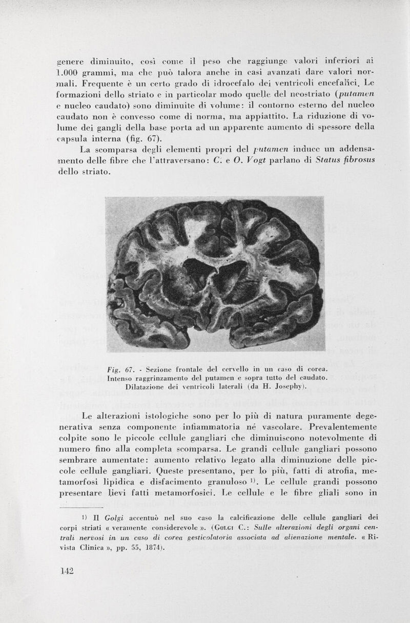 genere diminuito, così come il peso che raggiunge valori inferiori ai 1.000 grammi, ma clic può talora anche in casi avanzati dare valori nor mali. Frequente è un cerio grado ili idrocefalo dei ventricoli encefalici. Le formazioni dello strialo e in particolar modo quelle del neostriato (palameli e nucleo caudato) sono diminuite di volume: il contorno esterno del nucleo caudato non è convesso come di norma, ma appiattito. La riduzione di vo lume dei gangli della base porta ad un apparente aumento di spessore della capsula interna (fìg. 67). La scomparsa degli elementi propri del putamen induce un addensa mento delle fibre che l'attraversano: C. e O. Vogt parlano di Status fibrosus dello striato. Fig. 67. - Sezione frontale del cervello in un caso di corea. Intenso raggrinzamento del putamen e sopra tutto del caudato. Dilatazione dei ventricoli laterali (da H. Josephy). Le alterazioni istologiche sono per lo più di natura puramente dege nerativa senza componente infiammatoria né vascolare. Prevalentemente colpite sono le piccole cellule gangliari che diminuiscono notevolmente di numero fino alla completa scomparsa. Le grandi cellule gangliari possono sembrare aumentate: aumento relativo legalo alla diminuzione delle pic cole cellule gangliari. Queste presentano, per lo più, fatti di atrofia, me tamorfosi lipidica e disfacimento granuloso Le cellule grandi possono presentare lievi fatti metamorfosici. Le cellule e le fibre gliali sono in ') Il Golgi accentuò nel suo caso la calcificazione delje cellule gangliari dei corpi striati «veramente considerevole». ( Golgi C.: Sulle alterazioni degli organi cen trali nervosi in un caso di corea gesticolai or ia associata ad alienazione mentale. « Ri vista Clinica », pp. 55, 1874j.