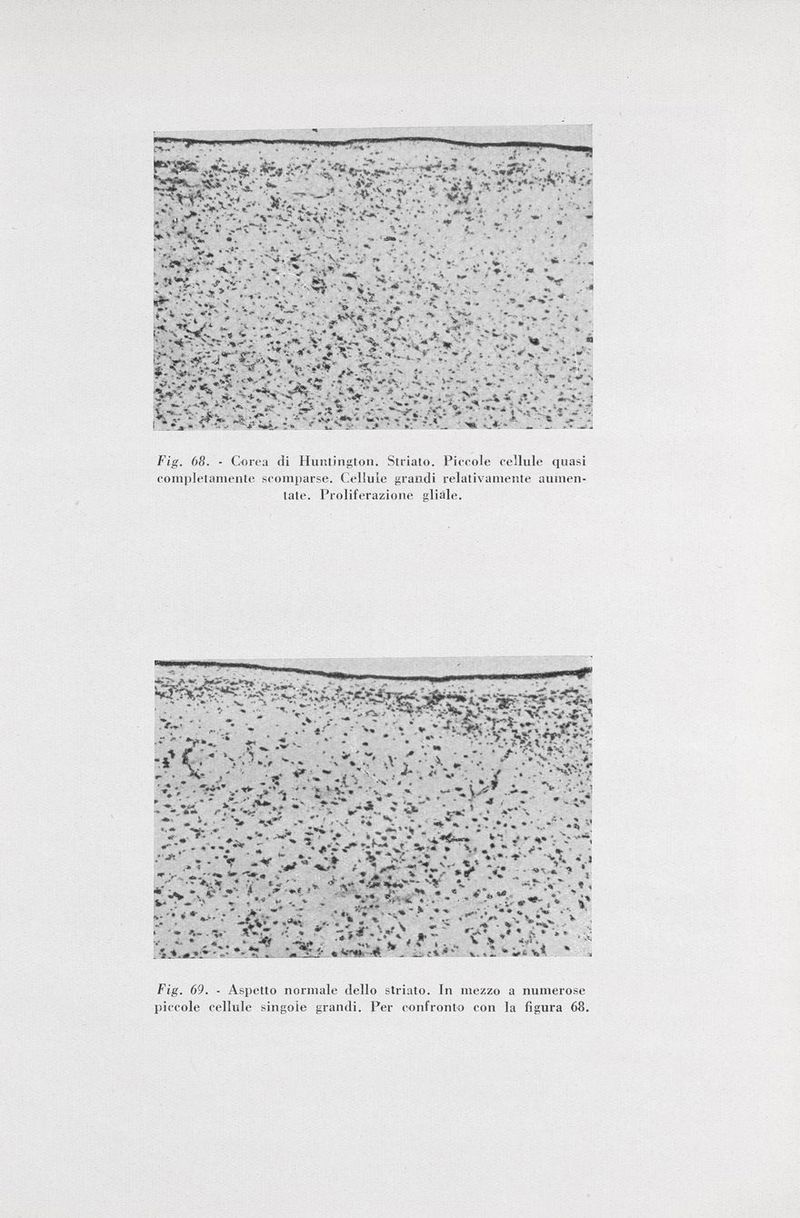 JvT- *  ' .  .'[T ' : T™ «***> «?* ;*y>iv'¿/ V'■ •* - ¿x • ' • '' : -  ;• * - V^*r^-■'%»■* <-. r: •' . . . ,# V* «. , •♦• < , - , j. ►  T * *L, * •»-*' , » \.iu - *** V - - « ■ , ♦ « _ » > l e •♦>£<.:v.-v;v • $.*> - -c t, - • ¿ à •** * ~~ ; •. *7«^* *** v*** . ♦ • •>. J* •*- > te**?-': .'■- ■: •• 4 r *  s£:-t*- r «v.\ •-;*.>• *. ** kir* t ^am ... r- *jlj. ?v ■■•-»■> .. r-#- % - v . «i- ¿& '■•- •- V> ,* ■ $** V^. ^ -' ••'¿>V,V>Ä ' >*;.-•-a ¿v* 'i.;«:. « i*;#r,•*>ú.i,• .-• - „r ml • m,;«_•? # li Ftg. 68. - Corea tli Huntington. Striato. Piccole cellule quasi completamente scomparse. Cellule grandi relativamente aumen tate. Proliferazione gliàle. i 1 y** HSr 4 *' «r ^ *ä , i. t.' •n ». ' • T •.- '>W?V « . - V« ,v ) ' A - • • . s5 * - I i »V * » ':^S * >•' 1 ^ ^ 'V* ** ^ *. ■ «%*v • ^ 5 « ^JL * % * */ % . , » n¿V„* Vf * ' , %% . - ^ «ÈtT^V .• * *: * V ^ V *> * % ?*,(■* *X4 * I t -»^r ^ ^„y « * v.- s « i * , ... «r-t». *■ . ' « .»'7 V *r,- »(<• .<• » 5 ♦ <•**  -V »«'• » *-*.* '-fi %*» v * V* -t>••,-*■• t. ^>- * -   » **>« ' * T •»' • *- „ *L . î*.«-•.'* ' • , »< w »i** :*»j¿ -V » il;'..;*.»' •»• - , **. % % - •- * Ä^» .. - ' V * « * * #* «y % * V *-y»í\v¿ »t 5, ^\-y ; Ts- . .-j *->i »\i-Ä. - : Fjg. 69. - Aspetto normale dello striato. In mezzo a numerose piccole cellule singole grandi. Per confronto con la figura 68.