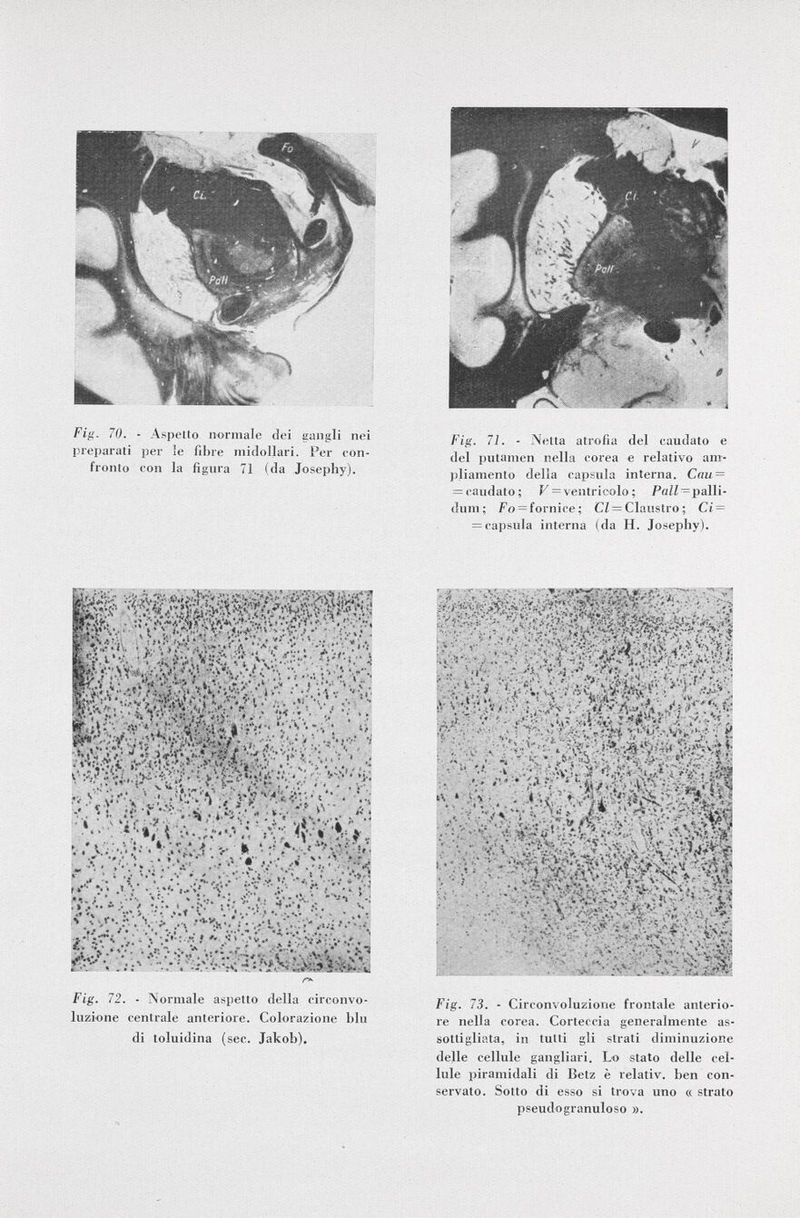 Fig. 71. - Netta atrofia del caudato e del putamen nella corea e relativo am pliamento della capsula interna. Cau = acaudato; V = ventricolo ; Pali — palli- dum; Fo = fornice; CI= Claustro; Ci = = capsula interna (da H. Josephy). Fig. 70. preparati fronto - Aspetto normale dei gangli nei per le fibre midollari. Per con- con la figura 71 (da Josephy). Fig. 72. - Normale aspetto della circonvo luzione centrale anteriore. Colorazione blu di toluidina (sec. Jakob). Fig. 73. - Circonvoluzione frontale anterio re nella corea. Corteccia generalmente as sottigliata, in tutti gli strati diminuzione delle cellule gangliari. Lo stato delle cel lule piramidali di Betz è relativ, ben con servato. Sotto di esso si trova uno « strato pseudogranuloso ».