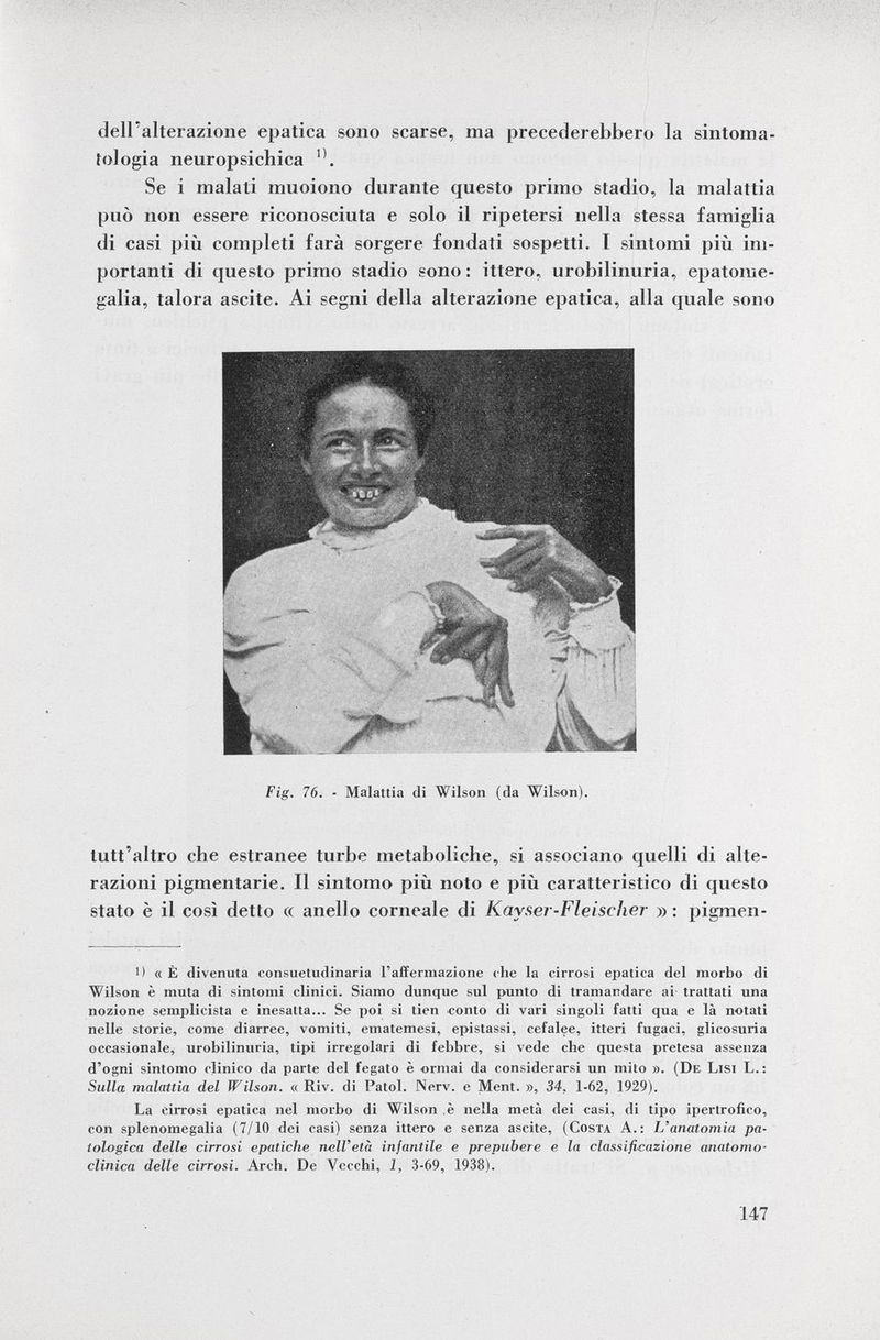 dell'alterazione epatica sono scarse, ma precederebbero la sintoma tologia neuropsichica Se i malati muoiono durante questo primo stadio, la malattia può non essere riconosciuta e solo il ripetersi nella stessa famiglia di casi più completi farà sorgere fondati sospetti. T sintomi più im portanti di questo primo stadio sono: ittero, urobilinuria, epatome galia, talora ascite. Ai segni della alterazione epatica, alla quale sono tutt'altro che estranee turbe metaboliche, si associano quelli di alte razioni pigmentarie. Il sintomo più noto e più caratteristico di questo stato è il così detto « anello corneale di Kay ser-Fleische?- » : pigmeii- ') « È divenuta consuetudinaria l'affermazione che la cirrosi epatica del morbo di Wilson è muta di sintomi clinici. Siamo dunque sul punto di tramandare ai trattati una nozione semplicista e inesatta... Se poi si tien conto di vari singoli fatti qua e là notati nelle storie, come diarree, vomiti, ematemesi, epistassi, cefalee, itteri fugaci, glicosuria occasionale, urobilinuria, tipi irregolari di febbre, si vede che questa pretesa assenza d'ogni sintomo clinico da parte del fegato è ormai da considerarsi un mito ». (De Lisi L.: Sulla malattia del Wilson. « Riv. di Patol. Nerv, e Ment. », 34, 1-62, 1929). La cirrosi epatica nel morbo di Wilson è nella metà dei casi, di tipo ipertrofico, con splenomegalia (7/10 dei casi) senza ittero e senza ascite, ( Costa A.: L'anatomia pa tologica delle cirrosi epatiche nell'età infantile e prepubere e la classificazione anatomo- clinica delle cirrosi. Arch. De Vecchi, 1, 3-69, 1938). Fig. 76. - Malattia di Wilson (da Wilson).