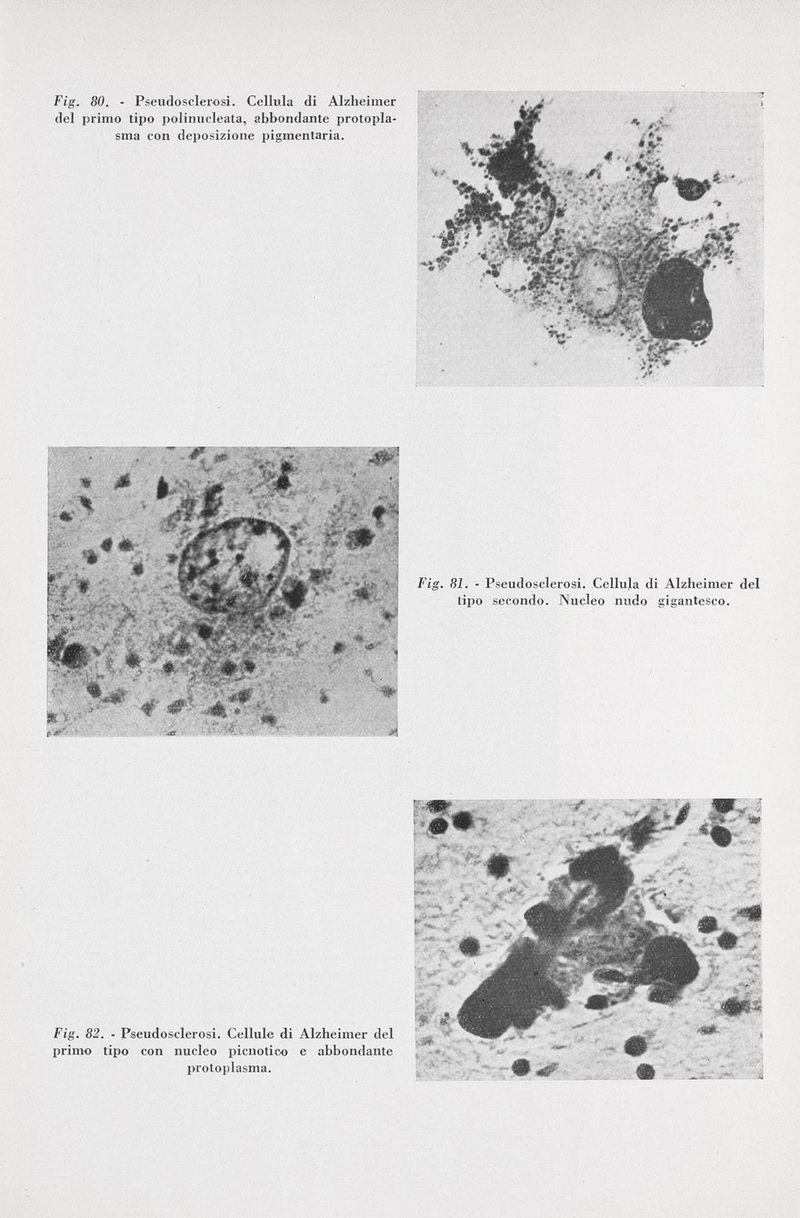 Fig. 80. - Pseudosclerosi. Cellula di Alzheimer del primo tipo polinueleata, abbondante protopla sma con deposizione pigmentaria. Fig. 81. - Pseudosclerosi. Cellula di Alzheimer del tipo secondo. Nucleo nudo gigantesco. Fig. 82. - Pseudosclerosi. Cellule di Alzheimer del primo tipo con nucleo picnotico e abbondante protoplasma.