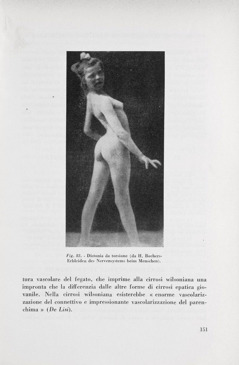 Fig. 83. - Distonia da torsione (da H. Bochers- Erbleiden des Nervensystems beim Menschen). tura vascolare del fegato, che imprime alla cirrosi wilsoniana una impronta che la differenzia dalle altre forme di cirrosi epatica gio vanile. Nella cirrosi wilsoniana esisterebbe « enorme vascolariz zazione del connettivo e impressionante vascolarizzazione del paren chima » (De Lisi).