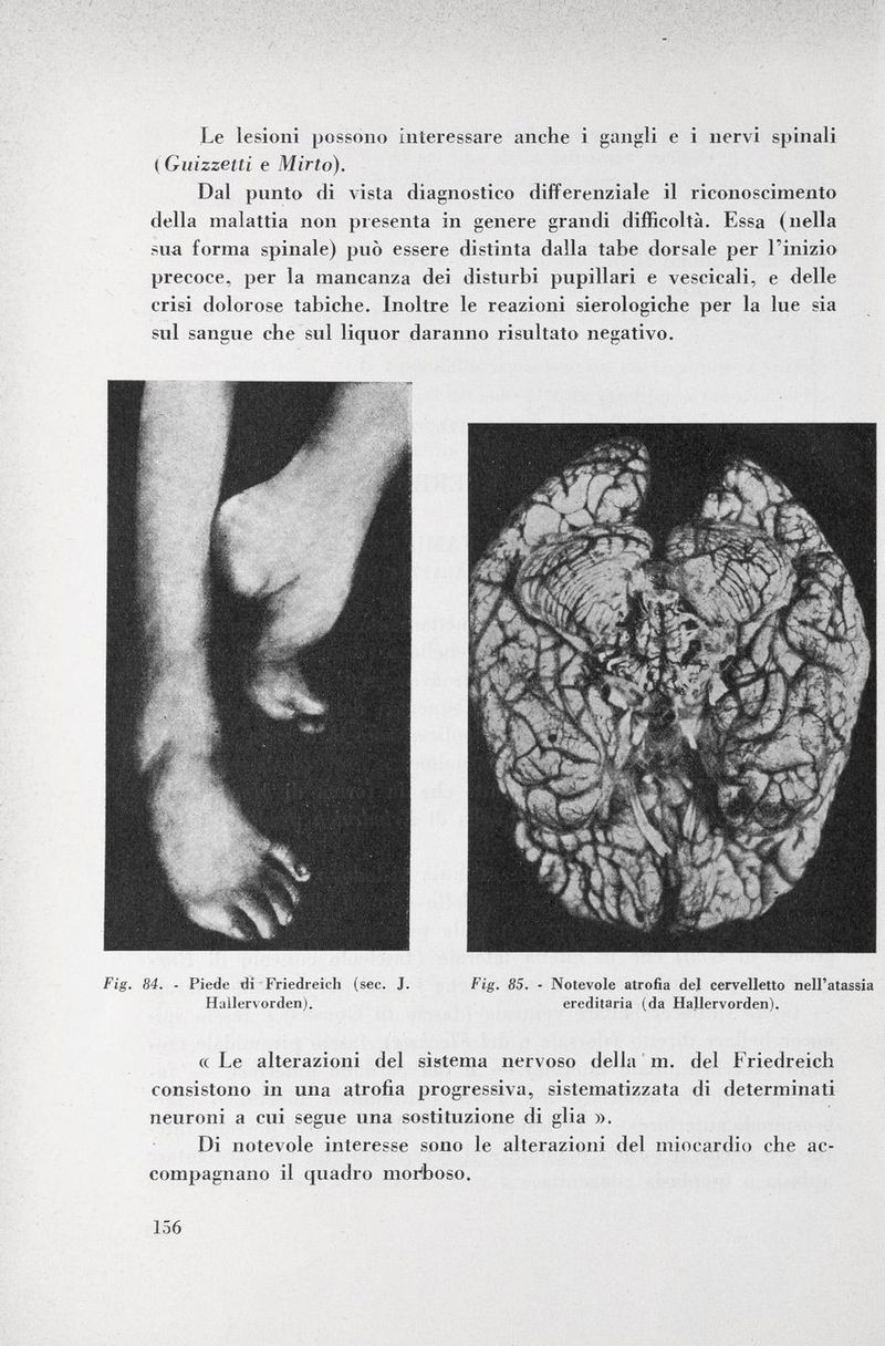 Le lesioni possono interessare anche i gangli e i nervi spinali < Guizzetti e Mirto). Dal punto di vista diagnostico differenziale il riconoscimento della malattia non presenta in genere grandi difficoltà. Essa (nella sua forma spinale) può essere distinta dalla tabe dorsale per l'inizio precoce, per la mancanza dei disturbi pupillari e vescicali, e delle crisi dolorose tabiche. Inoltre le reazioni sierologiche per la lue sia sul sangue che sul liquor daranno risultato negativo. Fig. 84. - Piede di Friedreich (sec. J. Fig. 85. • Notevole atrofia del cervelletto nell'atassia Hallervorden). ereditaria (da Hajlervorden). «Le alterazioni del sistema nervoso della m. del Friedreich consistono in una atrofia progressiva, sistematizzata di determinati neuroni a cui segue una sostituzione di glia ». Di notevole interesse sono le alterazioni del miocardio che ac compagnano il quadro morboso.