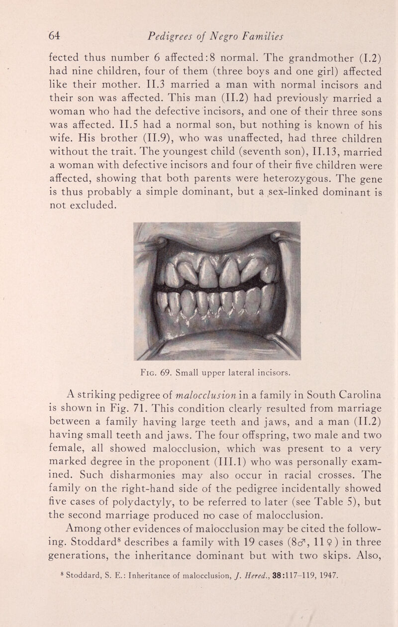 fected thus number 6 affected:8 normal. The grandmother (1.2) had nine children, four of them (three boys and one girl) affected like their mother. II.3 married a man with normal incisors and their son was affected. This man (II.2) had previously married a woman who had the defective incisors, and one of their three sons was affected. II.5 had a normal son, but nothing is known of his wife. His brother (II.9), who was unaffected, had three children without the trait. The youngest child (seventh son), 11.13, married a woman with defective incisors and four of their five children were affected, showing that both parents were heterozygous. The gene is thus probably a simple dominant, but a sex-linked dominant is not excluded. Fig. 69. Small upper lateral incisors. A striking pedigree of malocclusion in a family in South Carolina is shown in Fig. 71. This condition clearly resulted from marriage between a family having large teeth and jaws, and a man (II.2) having small teeth and jaws. The four offspring, two male and two female, all showed malocclusion, which was present to a very marked degree in the proponent (III. 1) who was personally exam ined. Such disharmonies may also occur in racial crosses. The family on the right-hand side of the pedigree incidentally showed five cases of polydactyly, to be referred to later (see Table 5), but the second marriage produced no case of malocclusion. Among other evidences of malocclusion may be cited the follow ing. Stoddard 8 describes a family with 19 cases (8d% 11 9) in three generations, the inheritance dominant but with two skips. Also, 8 Stoddard, S. E.: Inheritance of malocclusion, /. Hered., 38:117-119, 1947.