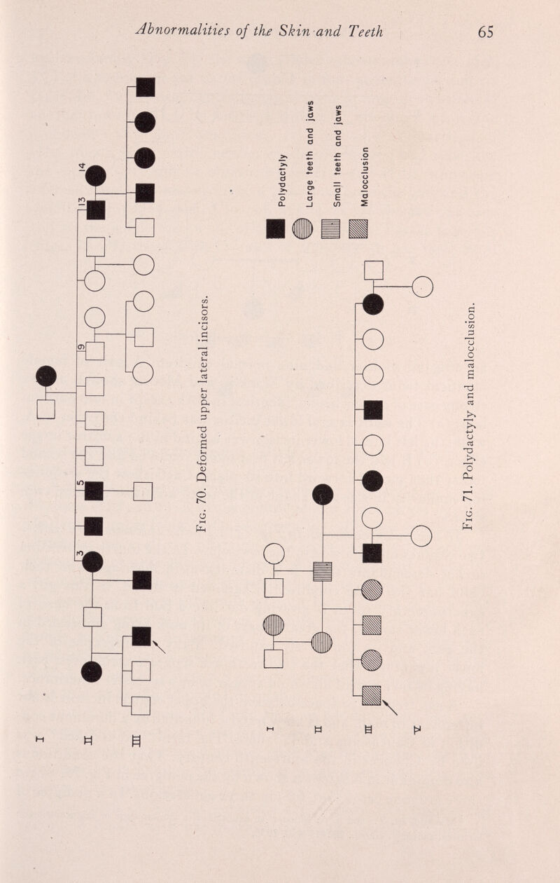 H nr • ■ 1 i 1 1 \] tO ¿)t ■ II : o i 13 14 Fig. 70. Deformed upper lateral incisors. Polydactyly Large teeth and jaws Small teeth and jaws Malocclusion Fig. 71. Polydactyly and malocclusion. ON Ln Abnormalities of the Skin and Teeth