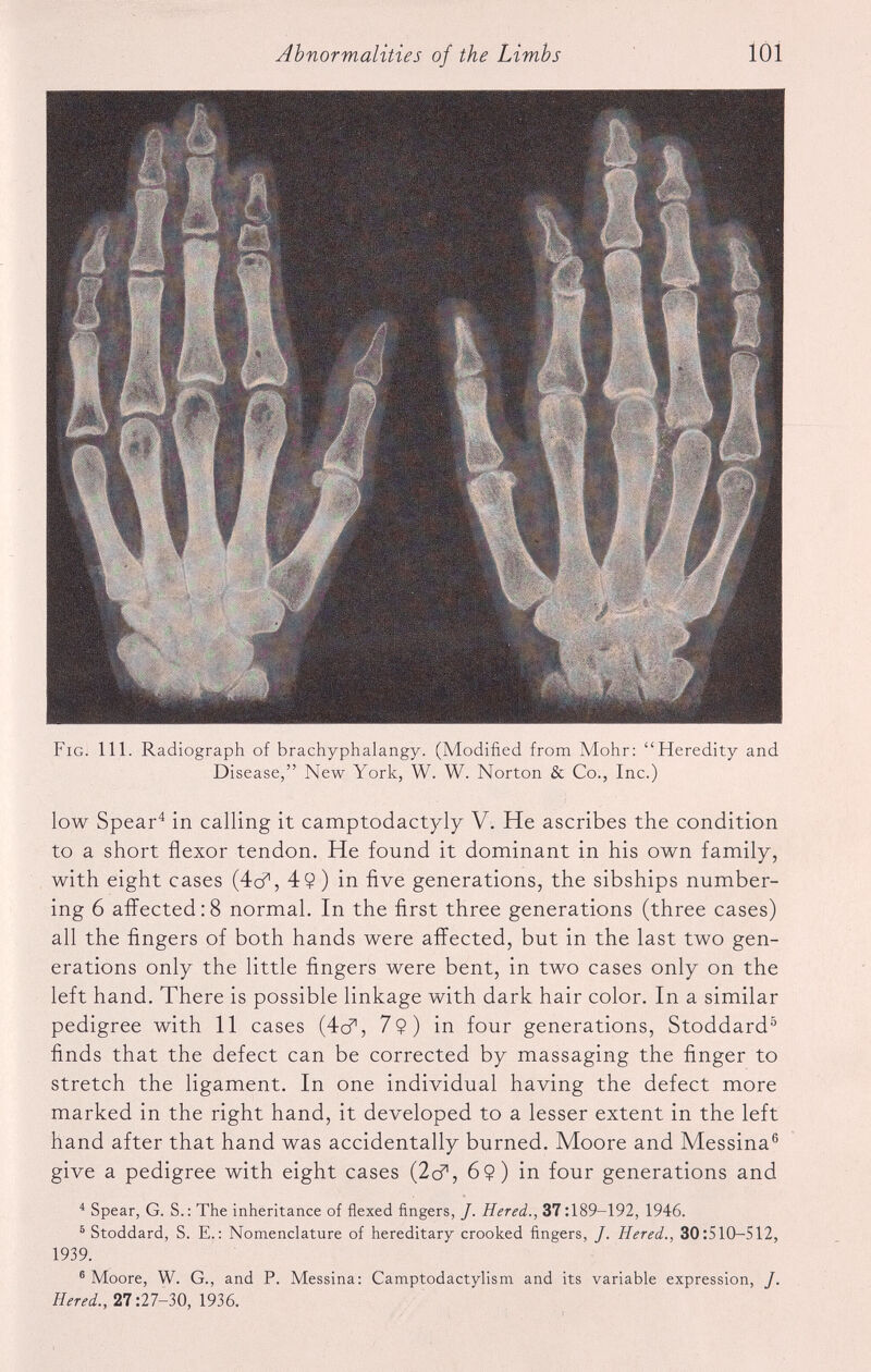 Fig. 111. Radiograph of brachyphalangy. (Modified from Mohr: “Heredity and Disease,” New York, W. W. Norton & Co., Inc.) low Spear 4 in calling it camptodactyly V. He ascribes the condition to a short flexor tendon. He found it dominant in his own family, with eight cases (4c?, 4$ ) in five generations, the sibships number ing 6 affected:8 normal. In the first three generations (three cases) all the fingers of both hands were affected, but in the last two gen erations only the little fingers were bent, in two cases only on the left hand. There is possible linkage with dark hair color. In a similar pedigree with 11 cases (4c?, 7 9) in four generations, Stoddard 5 finds that the defect can be corrected by massaging the finger to stretch the ligament. In one individual having the defect more marked in the right hand, it developed to a lesser extent in the left hand after that hand was accidentally burned. Moore and Messina 6 give a pedigree with eight cases (2c?, 6$) in four generations and 4 Spear, G. S.: The inheritance of flexed fingers, /. Hered., 37:189-192, 1946. 5 Stoddard, S. E.: Nomenclature of hereditary crooked fingers, J. Hered., 30:510-512, 1939. 6 Moore, W. G., and P. Messina: Camptodactylism and its variable expression, J. Hered., 27:27-30, 1936.