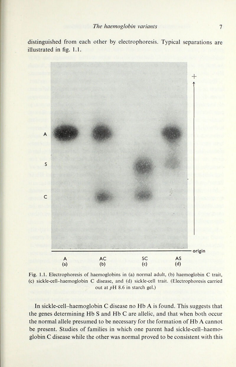 The haemoglobin variants 1 distinguished from each other by electrophoresis. Typical separations are illustrated in fig. 1.1. — — origin A AC SC AS (a) (b) (c) (d) Fig. 1.1. Electrophoresis of haemoglobins in (a) normal adult, (b) haemoglobin С trait, (c) sickle-cell-haemoglobin С disease, and (d) sickle-cell trait. (Electrophoresis carried out at pH 8.6 in starch gel.) In sickle-cell-haemoglobin С disease no Hb A is found. This suggests that the genes determining Hb S and Hb С are allelic, and that when both occur the normal allele presumed to be necessary for the formation of Hb A cannot be present. Studies of families in which one parent had sickle-cell-haemo- globin С disease while the other was normal proved to be consistent with this