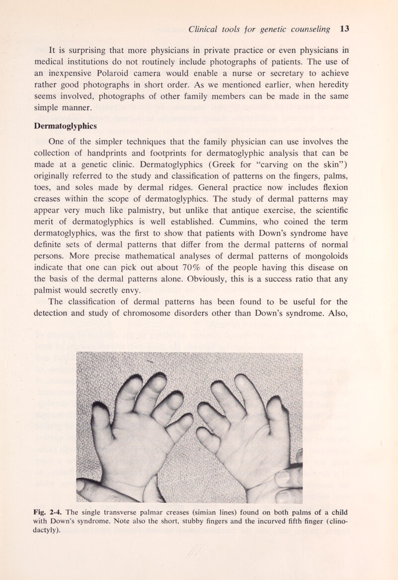 Clinical tools for genetic counseling 13 It is surprising that more physicians in private practice or even physicians in medical institutions do not routinely include photographs of patients. The use of an inexpensive Polaroid camera would enable a nurse or secretary to achieve rather good photographs in short order. As we mentioned earlier, when heredity seems involved, photographs of other family members can be made in the same simple manner. Dermatoglyphics One of the simpler techniques that the family physician can use involves the collection of handprints and footprints for dermatoglyphic analysis that can be made at a genetic clinic. Dermatoglyphics (Greek for carving on the skin) originally referred to the study and classification of patterns on the fingers, palms, toes, and soles made by dermal ridges. General practice now includes flexion creases within the scope of dermatoglyphics. The study of dermal patterns may appear very much like palmistry, but unlike that antique exercise, the scientific merit of dermatoglyphics is well established. Cummins, who coined the term dermatoglyphics, was the first to show that patients with Down's syndrome have definite sets of dermal patterns that differ from the dermal patterns of normal persons. More precise mathematical analyses of dermal patterns of mongoloids indicate that one can pick out about 70% of the people having this disease on the basis of the dermal patterns alone. Obviously, this is a success ratio that any palmist would secretly envy. The classification of dermal patterns has been found to be useful for the detection and study of chromosome disorders other than Down's syndrome. Also, dactyly).