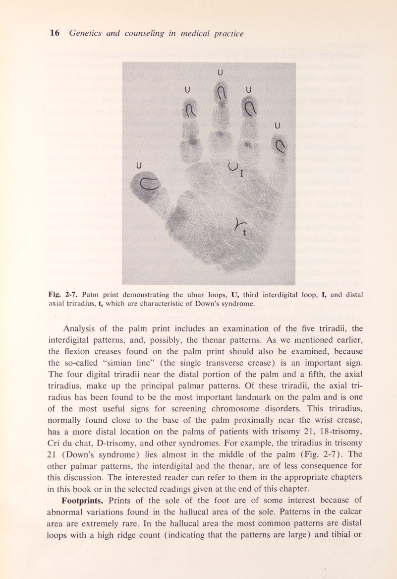 16 Genetics and counseling in medical practice Fig. 2-7. Palm print demonstrating the ulnar loops, U, third interdigital loop, I, and distal axial triradius, t, which are characteristic of Down's syndrome. Analysis of the palm print includes an examination of the five triradii, the interdigital patterns, and, possibly, the thenar patterns. As we mentioned earlier, the flexion creases found on the palm print should also be examined, because the so-called simian line (the single transverse crease) is an important sign. The four digital triradii near the distal portion of the palm and a fifth, the axial triradius, make up the principal palmar patterns. Of these triradii, the axial tri¬ radius has been found to be the most important landmark on the palm and is one of the most useful signs for screening chromosome disorders. This triradius, normally found close to the base of the palm proximally near the wrist crease, has a more distal location on the palms of patients with trisomy 21, 18-trisomy, Cri du chat, D-trisomy, and other syndromes. For example, the triradius in trisomy 21 (Down's syndrome) lies almost in the middle of the palm (Fig. 2-7). The other palmar patterns, the interdigital and the thenar, are of less consequence for this discussion. The interested reader can refer to them in the appropriate chapters in this book or in the selected readings given at the end of this chapter. Footprints. Prints of the sole of the foot are of some interest because of abnormal variations found in the hallucal area of the sole. Patterns in the calcar area are extremely rare. In the hallucal area the most common patterns are distal loops with a high ridge count (indicating that the patterns are large) and tibial or