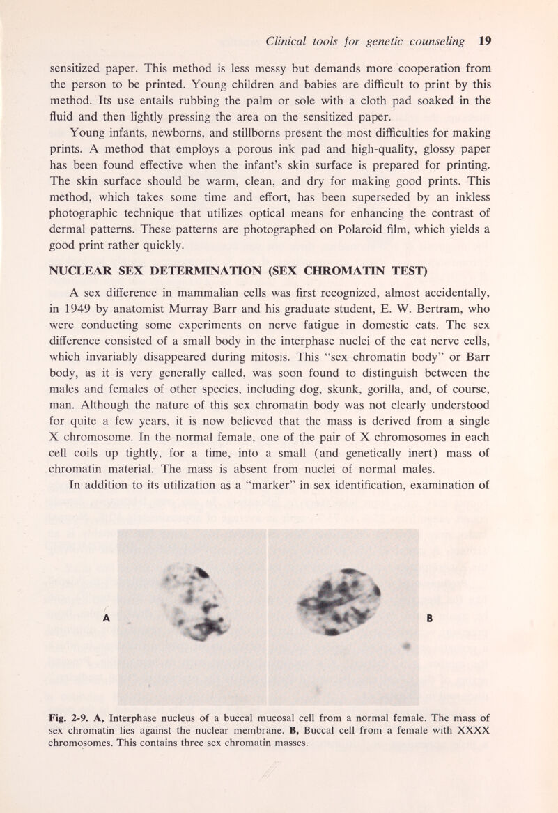 Clinical tools for genetic counseling 19 sensitized paper. This method is less messy but demands more cooperation from the person to be printed. Young children and babies are difficult to print by this method. Its use entails rubbing the palm or sole with a cloth pad soaked in the fluid and then lightly pressing the area on the sensitized paper. Young infants, newborns, and stillborns present the most difficulties for making prints. A method that employs a porous ink pad and high-quaUty, glossy paper has been found effective when the infant's skin surface is prepared for printing. The skin surface should be warm, clean, and dry for making good prints. This method, which takes some time and effort, has been superseded by an inkless photographic technique that utilizes optical means for enhancing the contrast of dermal patterns. These patterns are photographed on Polaroid film, which yields a good print rather quickly. NUCLEAR SEX DETERMINATION (SEX CHROMATIN TEST) A sex difference in mammalian cells was first recognized, almost accidentally, in 1949 by anatomist Murray Barr and his graduate student, E. W. Bertram, who were conducting some experiments on nerve fatigue in domestic cats. The sex difference consisted of a small body in the interphase nuclei of the cat nerve cells, which invariably disappeared during mitosis. This sex chromatin body or Barr body, as it is very generally called, was soon found to distinguish between the males and females of other species, including dog, skunk, gorilla, and, of course, man. Although the nature of this sex chromatin body was not clearly understood for quite a few years, it is now believed that the mass is derived from a single X chromosome. In the normal female, one of the pair of X chromosomes in each cell coils up tightly, for a time, into a small (and genetically inert) mass of chromatin material. The mass is absent from nuclei of normal males. In addition to its utilization as a marker in sex identification, examination of # A В 4 Fig. 2-9. A, Interphase nucleus of a buccal mucosal cell from a normal female. The mass of sex chromatin lies against the nuclear membrane. B, Buccal cell from a female with XXXX chromosomes. This contains three sex chromatin masses.