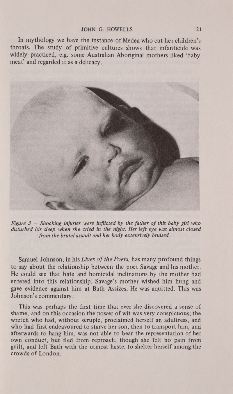 JOHN G. HOWELLS 21 In mythology we have the instance of Medea who cut her children's throats. The study of primitive cultures shows that infanticide was widely practiced, e.g. some Australian Aboriginal mothers liked 'baby meat' and regarded it as a delicacy. Figure 3 - Shocking injuries were inflicted by the father of this baby girl who disturbed his sleep when she cried in the night. Her left eye was almost closed from the brutal assault and her body extensively bruised Samuel Johnson, in his Lives of the Poets, has many profound things to say about the relationship between the poet Savage and his mother. He could see that hate and homicidal inclinations by the mother had entered into this relationship. Savage's mother wished him hung and gave evidence against him at Bath Assizes. He was aquitted. This was Johnson's commentary: This was perhaps the first time that ever she discovered a sense of shame, and on this occasion the power of wit was very conspicuous; the wretch who had, without scruple, proclaimed herself an adultress, and who had first endeavoured to starve her son, then to transport him, and afterwards to hang him, was not able to bear the representation of her own conduct, but fled from reproach, though she felt no pain from guilt, and left Bath with the utmost haste, to shelter herself among the crowds of London.