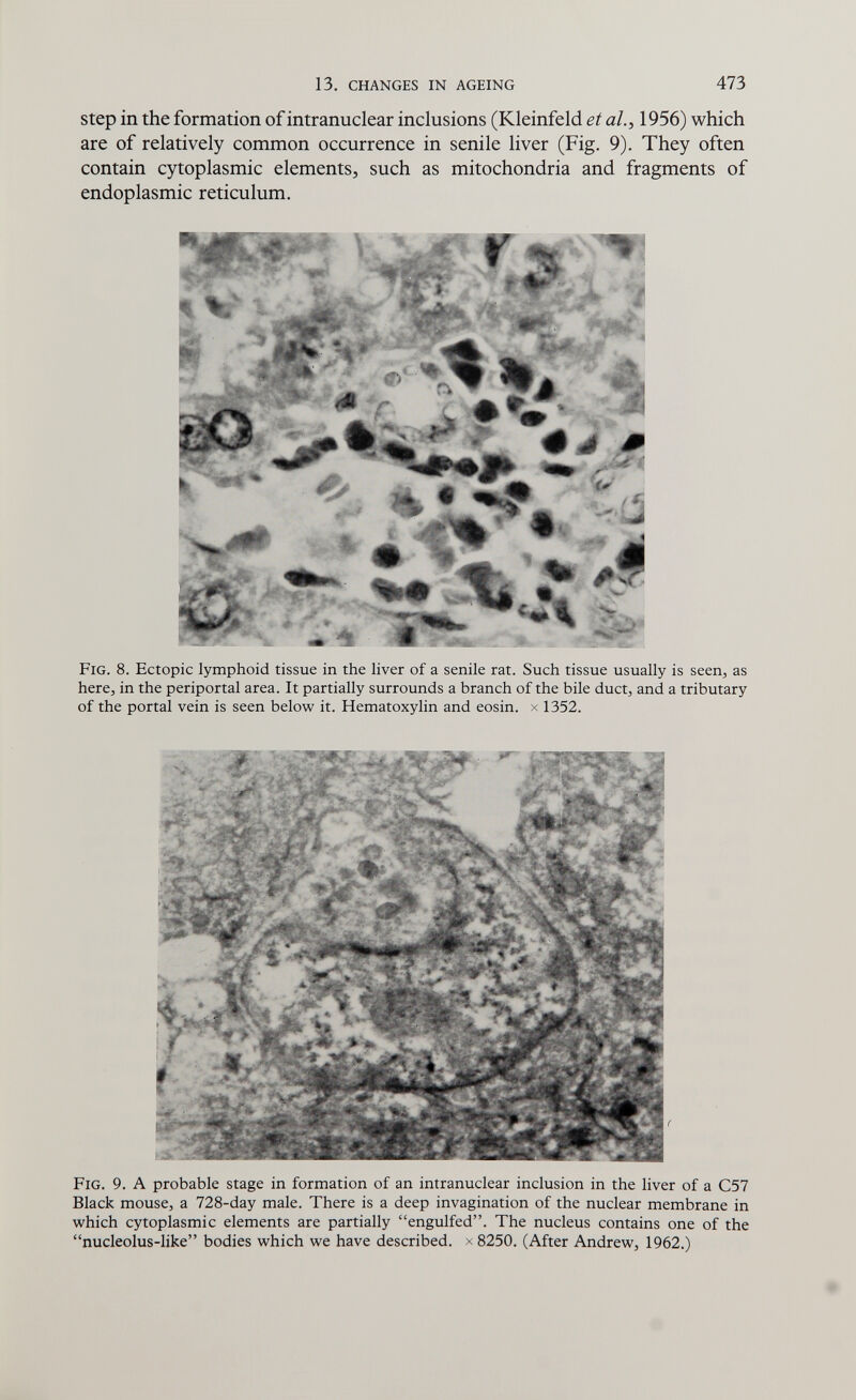 13. CHANGES IN AGEING 473 Step in the formation of intranuclear inclusions (Kleinfeld et al.^ 1956) which are of relatively common occurrence in senile liver (Fig. 9). They often contain cytoplasmic elements, such as mitochondria and fragments of endoplasmic reticulum. iL-»#*»«-.« m #»' # J Ш;. ЩЁЦ^^^Ёк Fig. 8. Ectopic lymphoid tissue in the liver of a senile rat. Such tissue usually is seen, as here, in the periportal area. It partially surrounds a branch of the bile duct, and a tributary of the portal vein is seen below it. Hematoxylin and eosin. x 1352. Fig. 9. A probable stage in formation of an intranuclear inclusion in the liver of a C57 Black mouse, a 728-day male. There is a deep invagination of the nuclear membrane in which cytoplasmic elements are partially engulfed. The nucleus contains one of the nucleolus-like bodies which we have described, x 8250. (After Andrew, 1962.)