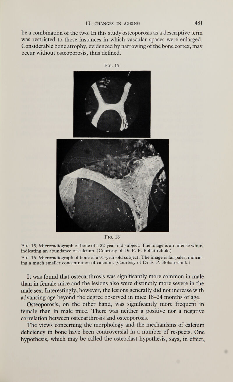 13. CHANGES IN AGEING 481 be a combination of the two. In this study osteoporosis as a descriptive term was restricted to those instances in which vascular spaces were enlarged. Considerable bone atrophy, evidenced by narrowing of the bone cortex, may occur without osteoporosis, thus defined. Fig. 15 Fig. 16 Fig. 15. Microradiograph of bone of a 22-year-old subject. The image is an intense white, indicating an abundance of calcium. (Courtesy of Dr F. P. Bohatirchuk.) Fig. 16. Microradiograph of bone of a 91-year-old subject. The image is far paler, indicat¬ ing a much smaller concentration of calcium. (Courtesy of Dr F. P. Bohatirchuk.) It was found that osteoarthrosis was significantly more common in male than in female mice and the lesions also were distinctly more severe in the male sex. Interestingly, however, the lesions generally did not increase with advancing age beyond the degree observed in mice 18-24 months of age. Osteoporosis, on the other hand, was significantly more frequent in female than in male mice. There was neither a positive nor a negative correlation between osteoarthrosis and osteoporosis. The views concerning the morphology and the mechanisms of calcium deficiency in bone have been controversial in a number of respects. One hypothesis, which may be called the osteoclast hypothesis, says, in effect.