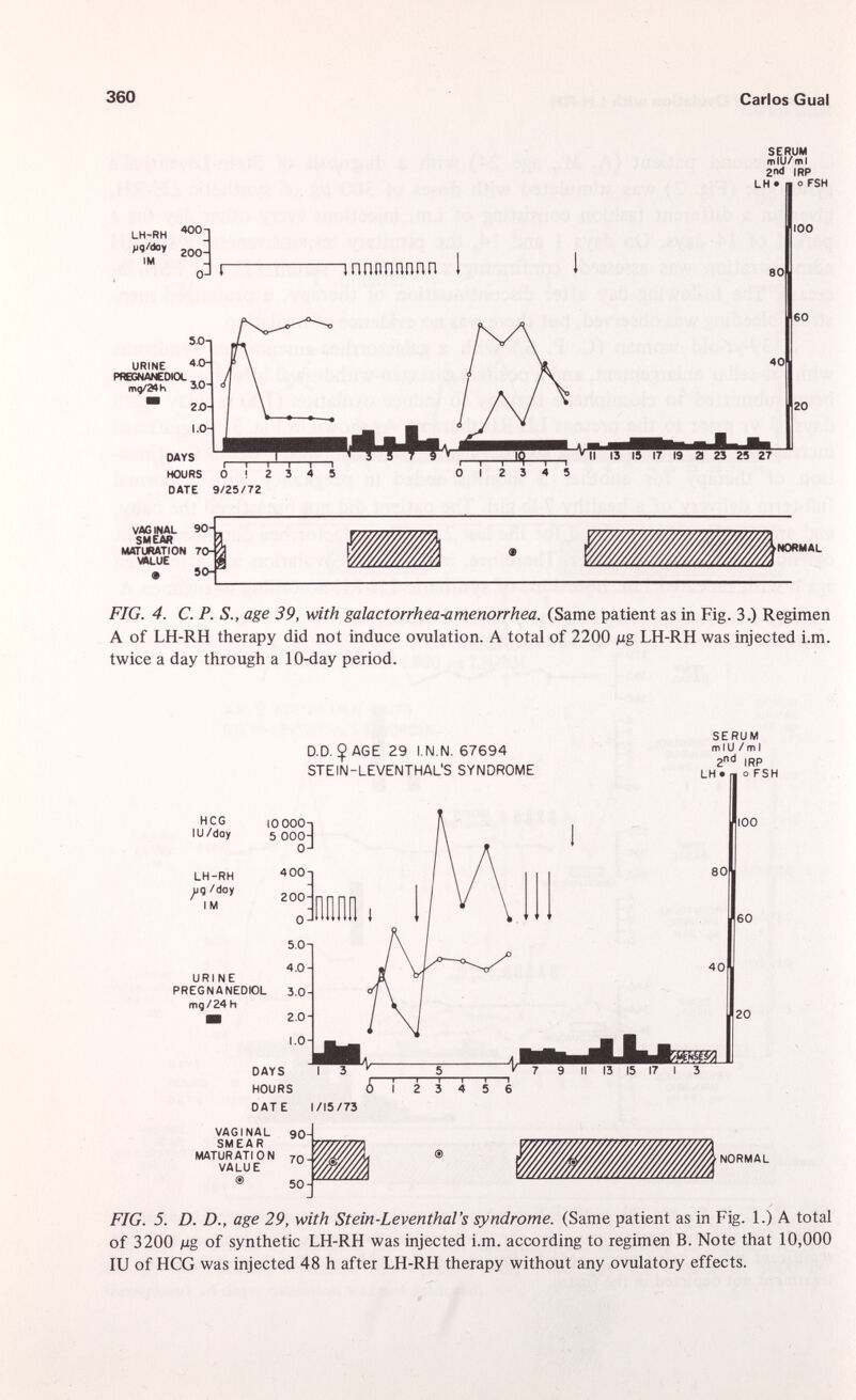 LH-RH ^ 0  1 200 5.0-1 URINE PREGNANEDIOL m9/24h *0 m 20- 1.0- DAYS HOURS SERUM mIU/ml 2nd IRP LH • m o FSH 100 innnnrmnn 80 O ! 2 3 DATE 9/25/72 4 5 60 20 12 3 4 5 VAG INAL 90i CU PAO MATURATION 70-| VALUE « 5 OH 'NORMAL FIG. 4. C. P. S., age 39, with galactorrhea-amenorrhea. (Same patient as in Fig. 3.) Regimen A of LH-RH therapy did not induce ovulation. A total of 2200 Mg LH-RH was injected i.m. twice a day through a 10-day period. D.D. $ AGE 29 I.N.N. 67694 STEIN-LEVENTHALS SYNDROME H CG lU /doy LH-RH jiq /day I M URINE PREGNANEDIOL mg /24 h I0 000-. 5 OOOH 0 J VAGI NAL SMEAR MATURATION VALUE ® IRP o FSH NORMAL FIG. 5. D. D., age 29, with Stein-Leventhal's syndrome. (Same patient as in Fig. 1.) A total of 3200 Mg of synthetic LH-RH was injected i.m. according to regimen B. Note that 10,000 IU of HCG was injected 48 h after LH-RH therapy without any ovulatory effects.