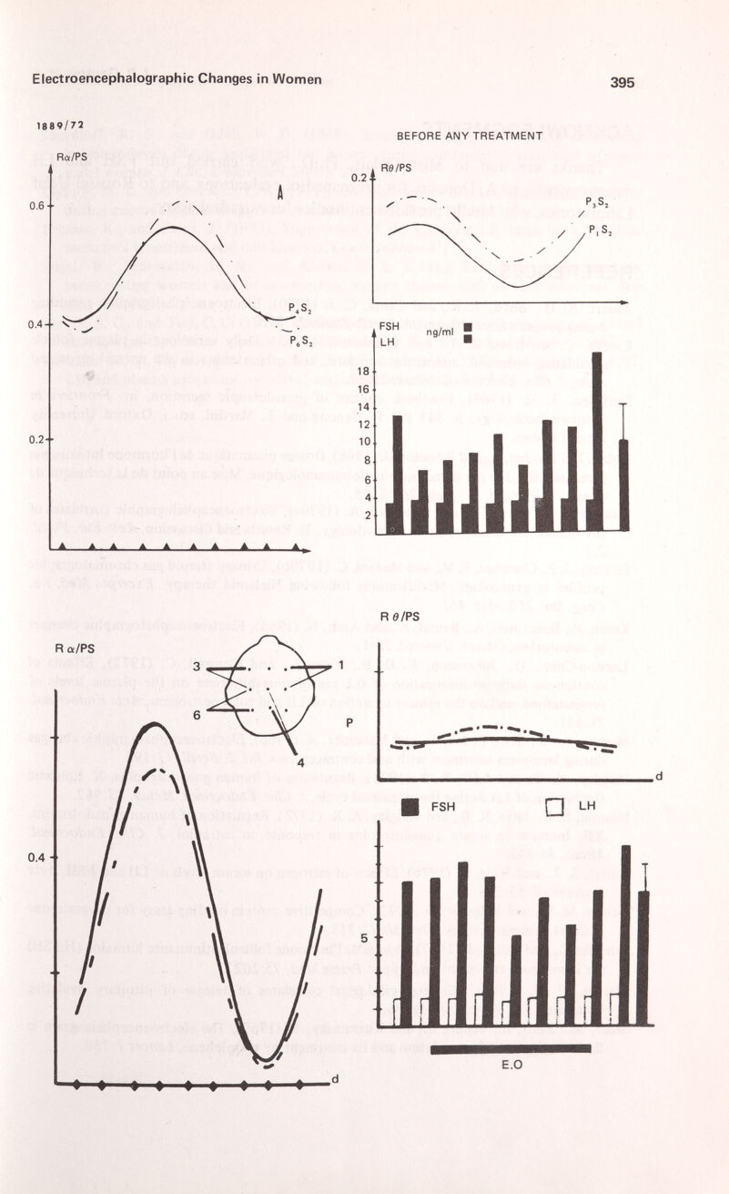 1889/72 Ra/PS 0.6 + 0.4-• V 0.2-■ P„S, P. S, 0.2 BEFORE ANY TREATMENT R0/PS P,S, P,S, 18 16 14 12 10 FSH LH ng/ml R 0/PS R a/PS 0.4 ■ urrsr- FSH □ LH 5 ■ ■ E.O