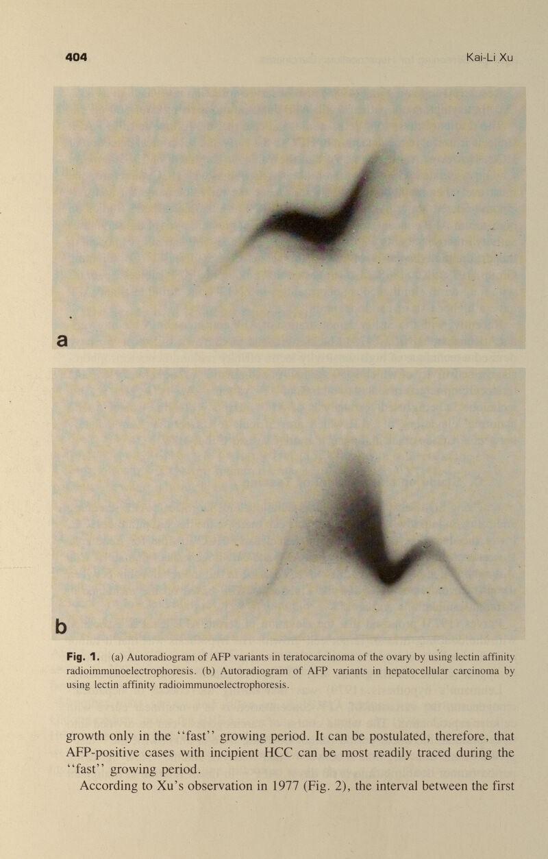 404 Kai-Li Xu Fig. 1. (а) Autoradiogram of AFP variants in teratocarcinoma of the ovary by using lectin affinity radioimmunoelectrophoresis. (b) Autoradiogram of AFP variants in iiepatocellular carcinoma by using lectin affinity radioimmunoelectrophoresis. growth only in the fast growing period. It can be postulated, therefore, that AFP-positive cases with incipient HCC can be most readily traced during the fast growing period. According to Xu's observation in 1977 (Fig. 2), the interval between the first