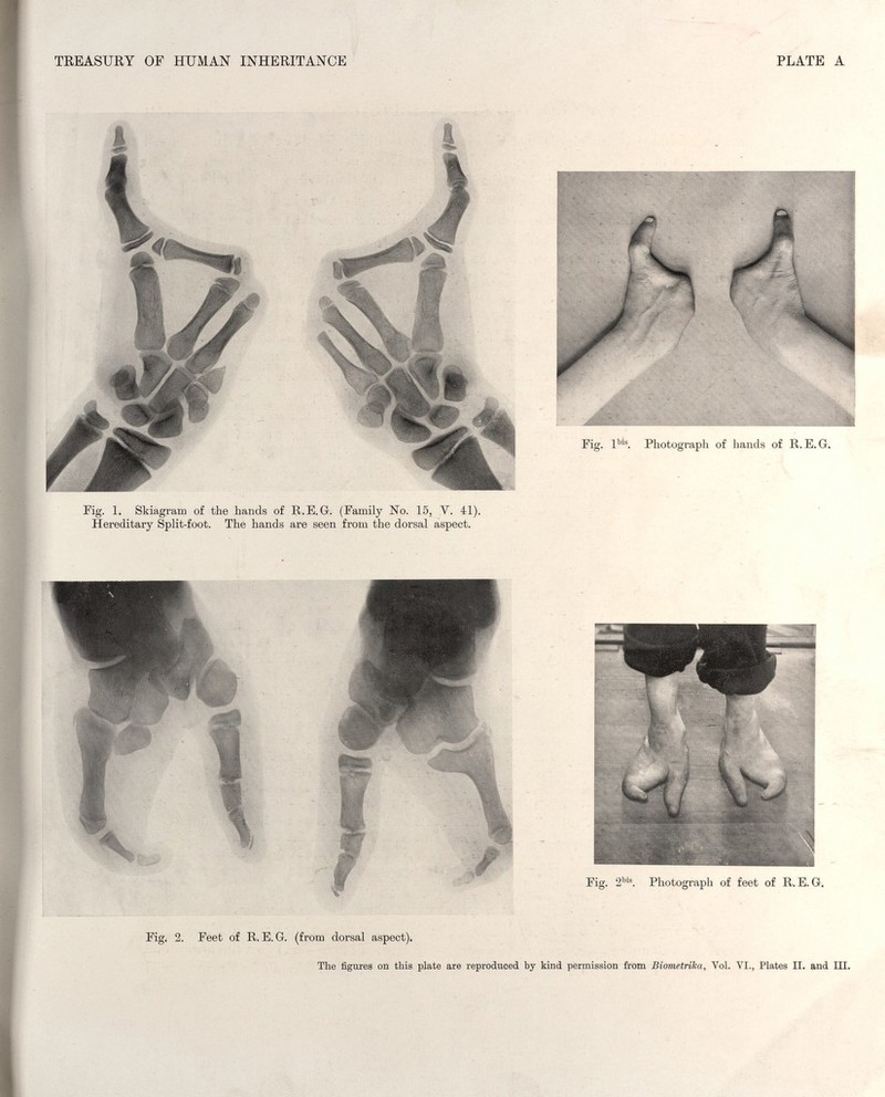 TREASURY OF HUMAN INHERITANCE PLATE A Fig. l'''®. Photograph of hands of R.E. G-. Pig. 1. Skiagram of the hands of R.E.G. (Family No. 15, V. 41). Hereditary Split-foot. The hands are seen from the dorsal aspect. Fig. 2''®. Photograph of feet of R.E.G. Fig. 2. Peet of R.E.G. (from dorsal aspect). The figures on this plate are reproduced by kind permission from Biome.tríka, Vol. VI., Plates II. and III.